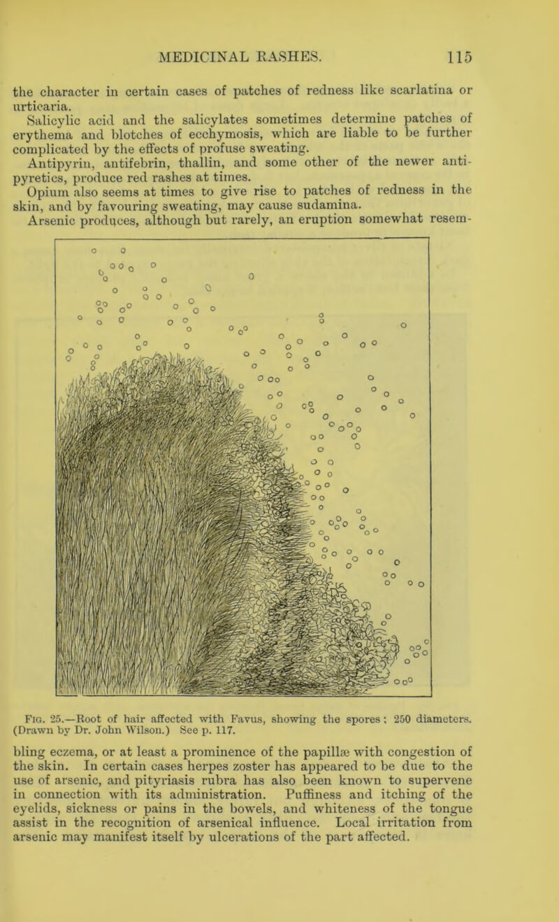 the character in certain cases of patches of redness like scarlatina or urticaria. Salicylic acid and the salicylates sometimes determine patches of erythema and blotches of ecchymosis, which are liable to be further complicated by the effects of profuse sweating. Antipyrin, antifebrin, thallin, and some other of the newer anti- pyretics, produce red rashes at times. Opium also seems at times to give rise to patches of redness in the skin, and by favouring sweating, may cause sudamina. Arsenic produces, although but rarely, an eruption somewhat resem- o o Fio. 25.—Root of hair affected with Favus, showing the spores : 250 diameters. (Drawn by Dr. John Wilson.) See p. 117. bling eczema, or at least a prominence of the papilla.1 with congestion of the skin. In certain cases herpes zoster has appeared to be due to the use of arsenic, and pityriasis rubra has also been known to supervene in connection with its administration. Puffiness and itching of the eyelids, sickness or pains in the bowels, and whiteness of the tongue assist in the recognition of arsenical influence. Local irritation from arsenic may manifest itself by ulcerations of the part affected.