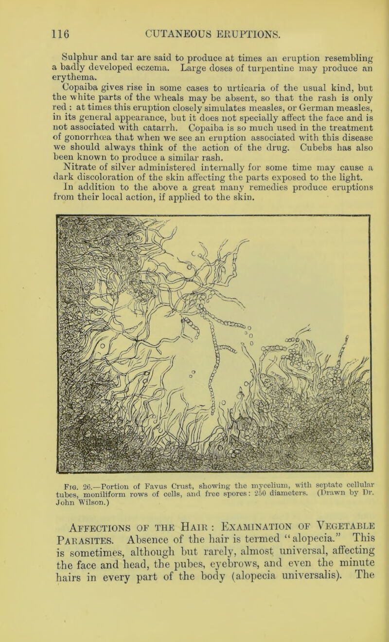Sulphur and tar are said to produce at times an eruption resembling a badly developed eczema. Large doses of turpentine may produce an erythema. Copaiba gives rise in some cases to urticaria of the usual kind, but the white parts of the wheals may be absent, so that the rash is only red : at times this eruption closely simulates measles, or German measles, in its general appearance, but it does not specially affect the face and is not associated with catarrh. Copaiba is so much used in the treatment of gonorrhoea that when we see an eruption associated with this disease we should always think of the action of the drug. Cubebs has also been known to produce a similar rash. Nitrate of silver administered internally for some time may cause a dark discoloration of the skin affecting the parts exposed to the light. In addition to the above a great many remedies produce eruptions from their local action, if applied to the skin. Fjg. 26.—Portion of Favus Crust, showing the mycelium, with septate cellular tubes, moniliform rows of cells, and free spores: 200 diameters. (Prawn by Pr. John Wilson.) Affections of the Hair : Examination of Vegetable Parasites. Absence of the hair is termed “alopecia.” This is sometimes, although but rarely, almost universal, affecting the face and head, the pubes, eyebrows, and even the minute hairs in every part of the body (alopecia universalis). The