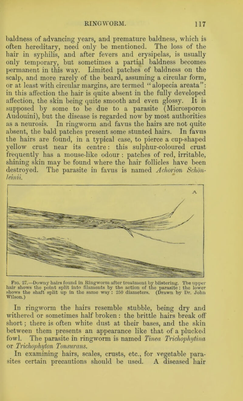 baldness of advancing years, and premature baldness, which is often hereditary, need only be mentioned. The loss of the hair in syphilis, and after fevers and erysipelas, is usually only temporary, but sometimes a partial baldness becomes permanent in this way. Limited patches of baldness on the scalp, and more rarely of the beard, assuming a circular form, or at least with circular margins, are termed “ alopecia areata”: in this affection the hair is quite absent in the fulljr developed affection, the skin being quite smooth and even glossy. It is supposed by some to be due to a parasite (Microsporon Audouini), but the disease is regarded now by most authorities as a neurosis. In ringworm and favus the hairs are not quite absent, the bald patches present some stunted hairs. In favus the hairs are found, in a typical case, to pierce a cup-shaped yellow crust near its centre: this sulphur-coloured crust frequently has a mouse-like odour : patches of red, irritable, shining skin may be found where the hair follicles have been destroyed. The parasite in favus is named Acliorion Schon- leinii. A Fio. 27.—Downy hairs found in Ringworm after treatment by blistering. The upper hair shows the point split into filamonts by the action of the parasite : the lower shows the shaft split up in the same way : 250 diameters. (Drawn by Dr. John Wilson.) In ringworm the hairs resemble stubble, being dry and withered or sometimes half broken : the brittle hairs break off short; there is often white dust at their bases, and the skin between them presents an appearance like that of a plucked fowl. The parasite in ringworm is named Tinea Trichophytina or Trichophyton Tonsurans. In examining hairs, scales, crusts, etc., for vegetable para- sites certain precautions should be used. A diseased hair