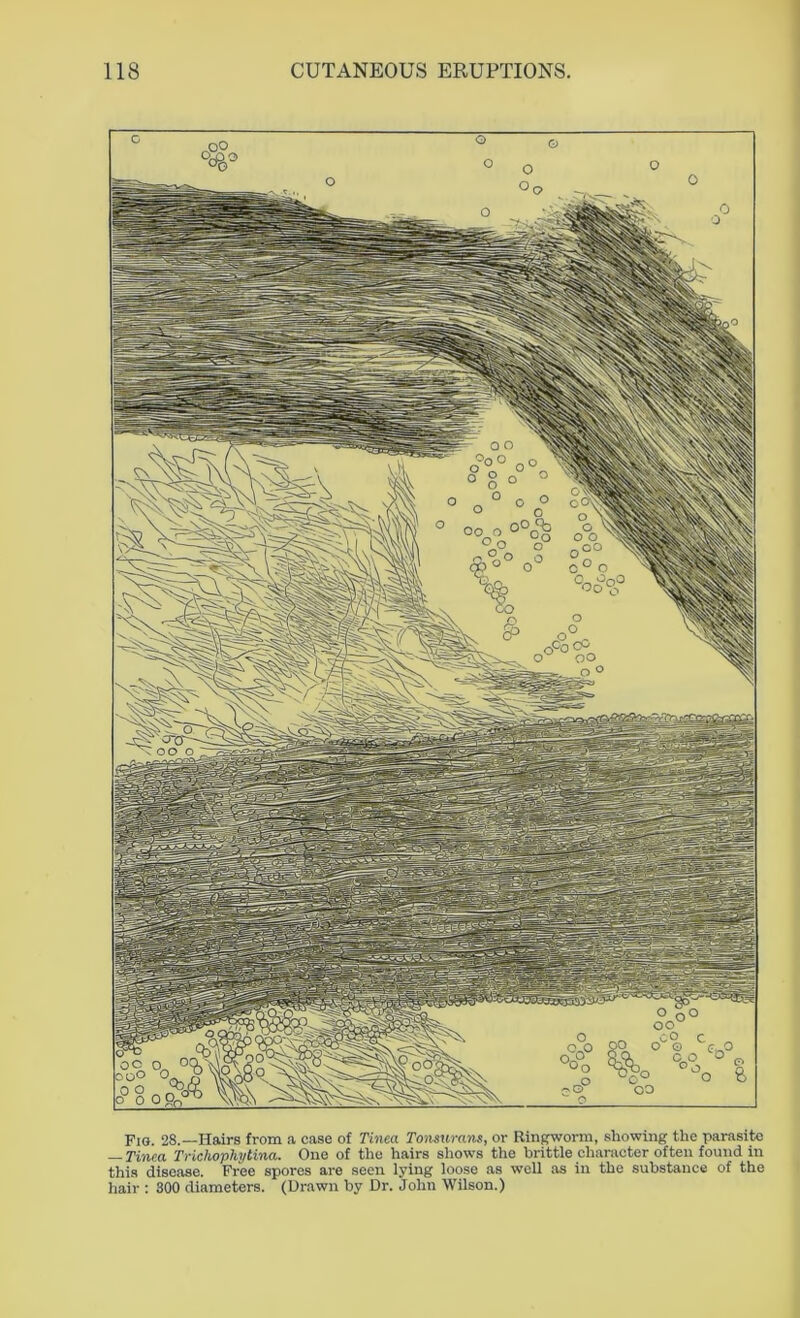 Fig. 28.—Hairs from a case of Tinea Tonsurans, or Ringworm, showing the parasite — Tinea Trichophytina. One of the hairs shows the brittle character often found in this disease. Free spores are seen lying loose as well as in the substance of the hair : 300 diameters. (Drawn by Dr. John Wilson.)