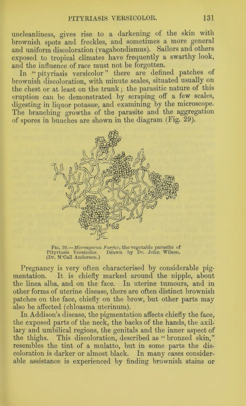 uncleanliness, gives rise to a darkening of the skin with brownish spots and freckles, and sometimes a more general and uniform discoloration (vagabondismus). Sailors and others exposed to tropical climates have frequently a swarthy look, and the influence of race must not be forgotten. In “ pityriasis versicolor ” there are defined patches of brownish discoloration, with minute scales, situated usually on the chest or at least on the trunk; the parasitic nature of this eruption can be demonstrated by scraping off a few scales, digesting in liquor potass*, and examining by the microscope. The branching growths of the parasite and the aggregation of spores in bunches are shown in the diagram (Fig. 29). Pregnancy is very often characterised by considerable pig- mentation. It is chiefly marked around the nipple, about the linea alba, and on the face. In uterine tumours, and in other forms of uterine disease, there are often distinct brownish patches on the face, chiefly on the brow, but other parts may also be affected (chloasma uterinum). In Addison’s disease, the pigmentation affects chiefly the face, the exposed parts of the neck, the backs of the hands, the axil- lary and umbilical regions, the genitals and the inner aspect of the thighs. This discoloration, described as “ bronzed skin,” resembles the tint of a mulatto, but in some parts the dis- coloration is darker or almost black. In many cases consider- able assistance is experienced by finding brownish stains or