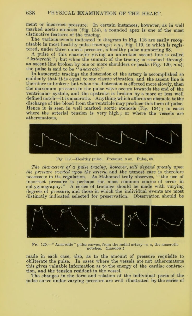 ment or incorrect pressure. In certain instances, however, as in well marked aortic stenosis (Pig. 134), a rounded apex is one of the most distinctive features of the tracing. The various events indicated in diagram in Fig. 118 are easily recog- nisable in most healthy pulse tracings; e.g., Fig. 119, in which is regis- tered, under three ounces pressure, a healthy pulse numbering 68. A pulse of this character giving an unbroken ascent line is called “ katacrotic ” ; but when the summit of the tracing is reached through an ascent line bi'oken by one or more shoulder's or peaks (Fig. 120, a a), the pulse is said to be “ anacrotic.” In katacrotic tracings the distension of the artery is accomplished so suddenly that it is equal to one elastic vibration, and the ascent line is therefore unbroken; but when the distension is effected more slowly, then the maximum pressure in the pulse wave occurs towards the end of the ventricular systole, and the upstroke is broken by a more or less well defined notch—it is anacrotic. Anything which affords an obstacle to the discharge of the blood from the ventricle may produce this form of pulse. Hence it is seen in well marked aortic stenosis (Fig. 134); in cases where the arterial tension is very high ; or where the vessels are atheromatous. Fig 119.—Healthy pulse. Pressure, 3 oz. Pulse, 6S. The characters of a pulse tracing, however, will depend greatly upcm the pressure exerted upon the artery, and the utmost care is therefore necessary in its regulation. As Mahomed truly observes, ‘ ‘ the use of incorrect pressure is perhaps the most common source of error in sphygmography.” A series of tracings should be made with varying degrees of pressure, and those in which the individual events are most distinctly indicated selected for preservation. Observation should be Fig. 120.—“ Anacrotic” pulse curves, from the radial artery—a a, the anacrotic notches. (Landois.) made in each case, also, as to the amount of pressure requisite to obliterate the pulse. In cases where the vessels are not atheromatous this gives valuable information as to the energy of the cardiac contrac- tion, and the tension resident in the vessel. The changes in the form and relation of the individual parts of the pulse curve under varying pressure are well illustrated by the series of