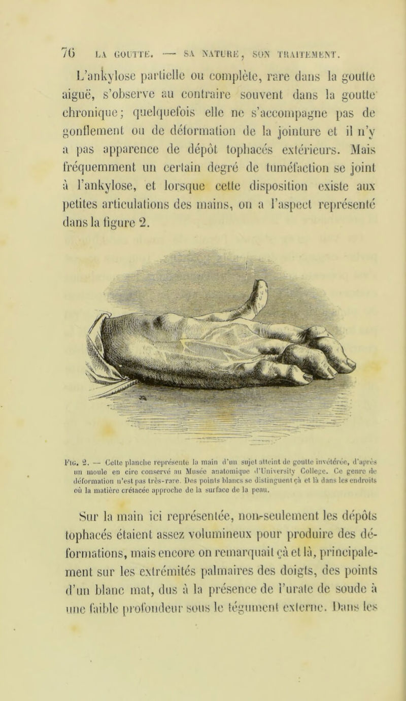 L’ankylose partielle ou complète, rare dans la goutte aiguë, s’observe au contraire souvent dans la goutte chronique; quelquefois elle ne s’accompagne pas de gonflement ou de déformation de la jointure et il n’y a pas apparence de dépôt topliaeés extérieurs. Mais fréquemment un certain degré de tuméfaction se joint à l’ankylose, et lorsque cette disposition existe aux petites articulations des mains, on a l’aspect représenté dans la figure 2. 1<’ig. 2. — Celle planche représente la main d'un sujet atteint de goutte invétérée, d'après un moule en cire conservé au Musce anatomique d’Universilv College. Ce genre de déformation n'est pas très-rai e. Des points blancs se distinguent çà et là dans les endroits où la matière crétacée approche de la surface de la peau. Sur la main ici représentée, non-seulement les dépôts tophacés étaient assez volumineux pour produire des dé- formations, mais encore on remarquait çà et là, principale- ment sur les extrémités palmaires des doigts, des points d’un blanc mat, dus à la présence de i’urate de soude à une faible profondeur sous le tégument externe. Dans les