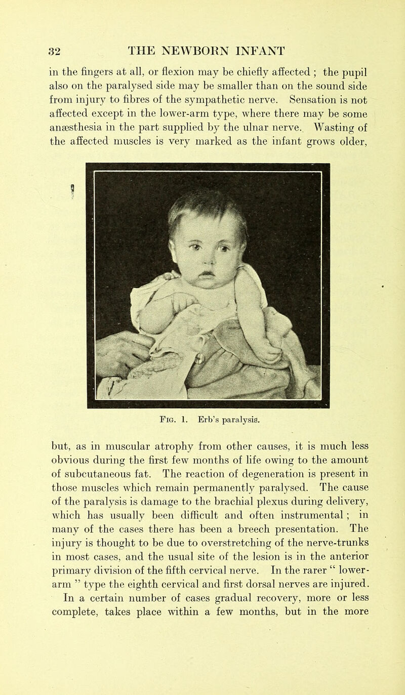in the fingers at all, or flexion may be chiefly affected ; the pupil also on the paralysed side may be smaller than on the sound side from injury to fibres of the sympathetic nerve. Sensation is not affected except in the lower-arm type, where there may be some anaesthesia in the part supplied by the ulnar nerve. Wasting of the affected muscles is very marked as the infant grows older, Fig. 1. Erb’s paralysis. but, as in muscular atrophy from other causes, it is much less obvious during the first few months of life owing to the amount of subcutaneous fat. The reaction of degeneration is present in those muscles which remain permanently paralysed. The cause of the paralysis is damage to the brachial plexus during delivery, which has usually been difficult and often instrumental ; in many of the cases there has been a breech presentation. The injury is thought to be due to overstretching of the nerve-trunks in most cases, and the usual site of the lesion is in the anterior primary division of the fifth cervical nerve. In the rarer “ lower- arm ” type the eighth cervical and first dorsal nerves are injured. In a certain number of cases gradual recovery, more or less complete, takes place within a few months, but in the more