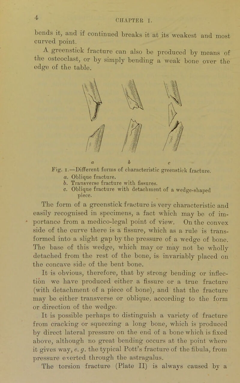 CHAPTER I. bends it, and if continued breaks it at its weakest and most curved point. A greenstick fracture can also be produced by means of the osteoclast, or by simply bending a weak bone over the edge of the table. a b c Fig. i.—Different forms of characteristic greenstick fracture. a. Oblique fracture. b. Transverse fracture with fissures. c. Oblique fracture with detachment of a wedge-shaped piece. The form of a greenstick fracture is very characteristic and easily recognised in specimens, a fact which may be of im- * portance from a medico-legal point of view. On the convex side of the curve there is a fissure, which as a rule is trans- formed into a slight gap by the pressure of a wedge of bone. The base of this wedge, which may or may not be wholly detached from the rest of the bone, is invariably placed on the concave side of the bent bone. It is obvious, therefore, that by strong bending or inflec- tion we have produced either a fissure or a true fracture (with detachment of a piece of bone), and that the fracture may be either transverse or oblique, according to the form or direction of the wedge. It is possible perhaps to distinguish a variety of fracture from crackiug or squeezing a long bone, which is produced by direct lateral pressure on the end of a bone which is fixed above, although no great bending occurs at the point where it gives way, e. g. the typical Pott’s fracture of the fibula, from pressure exerted through the astragalus. The torsion fracture (Plate II) is always caused by a