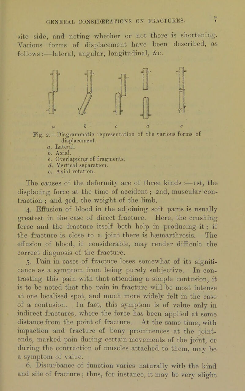 GENERAL CONSIDERATIONS ON FRACTURES. site side, and noting whether or not there is shortening. Various forms of displacement have been described, as follows :—lateral, angular, longitudinal, &c. abed e Fig. 2. —Diagrammatic representation of the various forms of displacement. a. Lateral. b. Axial. c. Overlapping of fragments. cl. Vertical separation. e. Axial rotation. The causes of the deformity are of three kinds :—ist, the displacing force at the time of accident; 2nd, muscular con- traction ; and 3rd, the weight of the limb. 4. Effusion of blood in the adjoining soft parts is usually greatest in the case of direct fracture. Here, the crushing force and the fracture itself both help in producing it; if the fracture is close to a joint there is haemarthrosis. The effusion of blood, if considerable, may render difficult the correct diagnosis of the fracture. 5. Pain in cases of fracture loses somewhat of its signifi- cance as a symptom from being purely subjective. In con- trasting this pain with that attending a simple contusion, it is to be noted that the pain in fracture will be most intense at one localised spot, and much more widely felt in the case of a contusion. In fact, this symptom is of value only in indirect fractures, where the force has been applied at some distance from the point of fracture. At the same time, with impaction and fracture of bony prominences at the joint- ends, marked pain during certain movements of the joint, or during the contraction of muscles attached to them, may be a symptom of value. 6. Disturbance of function varies naturally with the kind and site of fracture ; thus, for instance, it mav be very slight