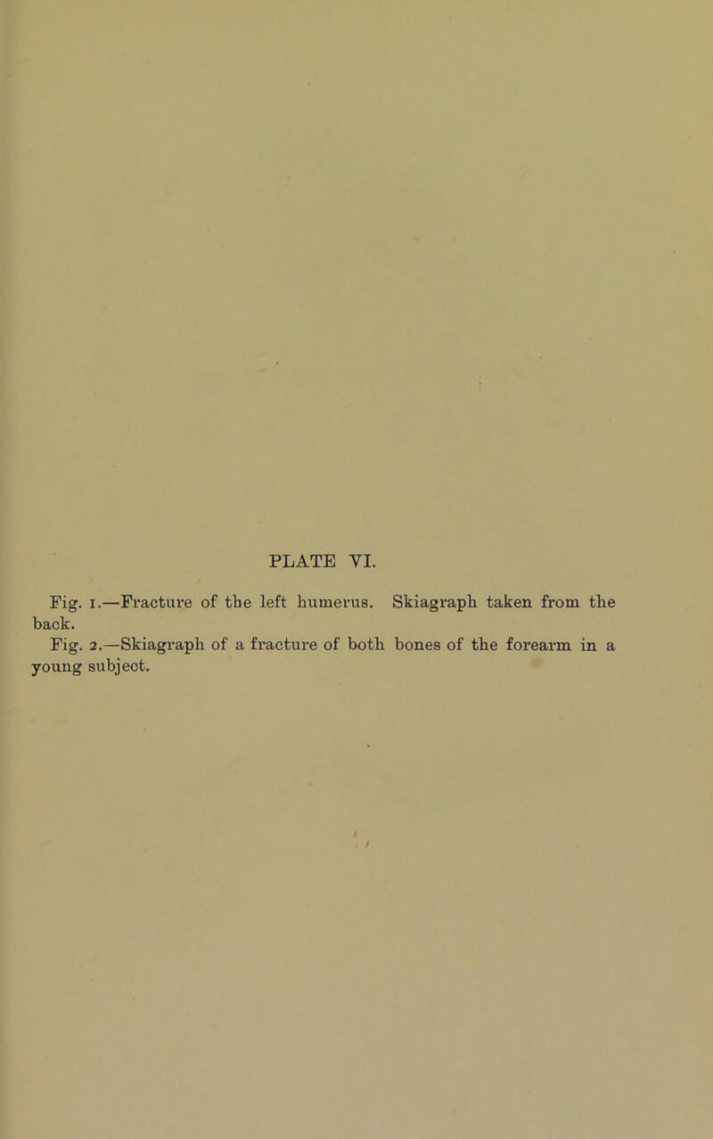 Pig. i.—Fracture of the left humerus. Skiagraph taken from the back. Fig. 2.—Skiagraph of a fracture of both bones of the forearm in a young subjeot.