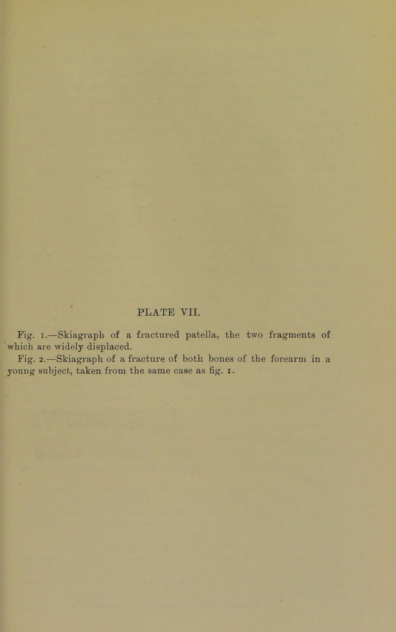 Fig. i.—Skiagraph of a fractured patella, the two fragments of which are widely displaced. Fig. 2.—Skiagraph of a fracture of both bones of the forearm in a young subject, taken from the same case as fig. i.
