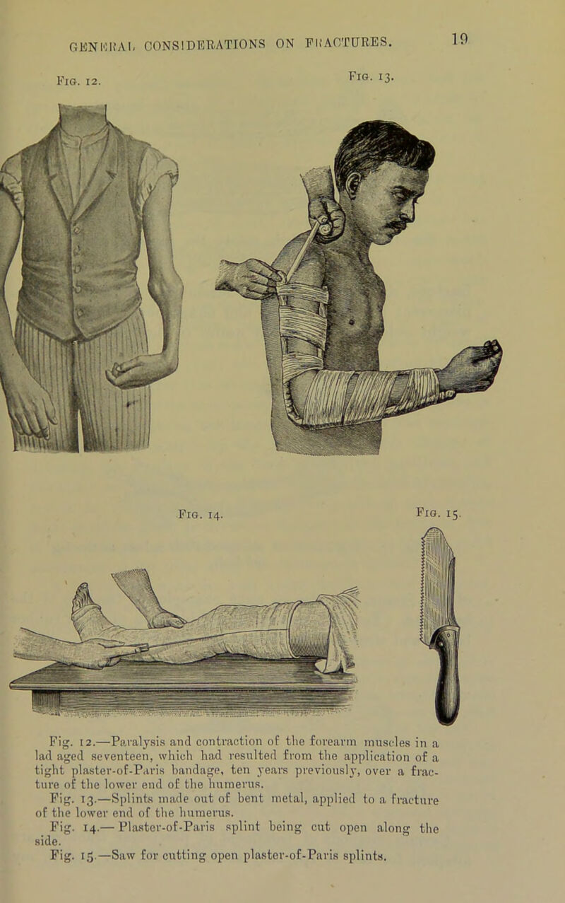 Fig. 12. Fig. 13. Fig. 14. Pig. 15. Fig. 12.—Paralysis and contraction of the forearm muscles in a lad aged seventeen, which had resulted from the application of a tight plaster-of-Paris bandage, ten years previously, over a frac- ture of the lower end of the humerus. Fig. 13.—Splints made out of bent metal, applied to a fracture of the lower end of the humerus. Fig. 14.— Plaster-of-Paris splint being cut open along the side. Fig. 15.—Saw for cutting open plaster-of-Paris splints.