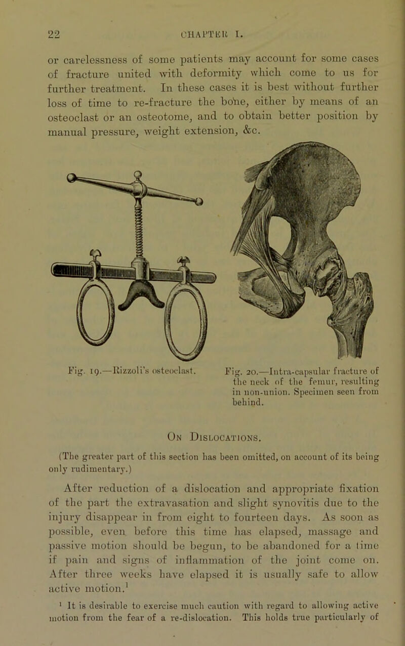 or carelessness of some patients may account for some cases of fracture united with deformity which come to us for further treatment. In these cases it is best without further loss of time to re-fracture the bohe, either by means of an osteoclast or an osteotome, and to obtain better position by manual pressure, weight extension, &c. Fig. iq.—Rizzoli’s osteoclast. Fig. 20.—Iutra-oapsular fracture of the neck of the femur, resulting in non-union. Specimen seen from behind. On Dislocations. (The greater part of this section has been omitted, on account of its being only rudimentary.) After reduction of a dislocation and appropriate fixation of the part the extravasation and slight synovitis due to the injury disappear in from eight to fourteen days. As soon as possible, even before this time has elapsed, massage and passive motion should be begun, to be abandoned for a time if pain and signs of inflammation of the joint come on. After three weeks have elapsed it is usually safe to allow active motion.1 1 It is desirable to exercise much caution with regard to allowing active motion from the fear of a re-dislocation. This holds true particularly of