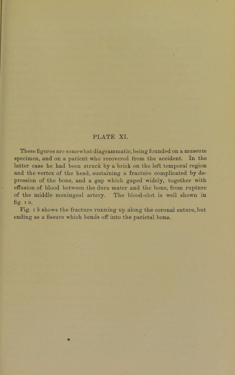 These figures are somewhat diagrammatic, being founded on a museum specimen, and on a patient who recovered from the accident. In the latter case he had been struck by a brick on the left temporal region and the vertex of the head, sustaining a fracture complicated by de- pression of the bone, and a gap which gaped widely, together with effusion of blood between the dura mater and the bone, from rupture of the middle meningeal artery. The blood-clot is well shown in fig. i a. Fig. i b shows the fracture running up along the coronal suture, but ending as a fissure which bends off into the parietal bone.