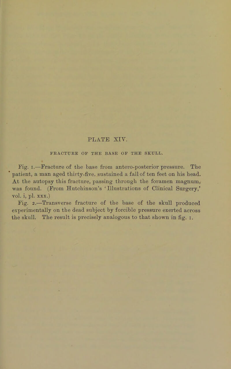 FRACTURE OF THE BASE OF THE SKULL. Fig. i.—Fracture of tlie base from antero-posterior pressure. The  patient, a man aged thirty-five, sustained a fall of ten feet on his head. At the autopsy this fracture, passing through the foramen magnum, was found. (From Hutchinson’s ‘Illustrations of Clinical Surgery,’ vol. i, pi. xxx.) Fig. 2.—Transverse fracture of the base of the skull produced experimentally on the dead subject by forcible pressure exerted across the skull. The result is precisely analogous to that shown in fig. i.