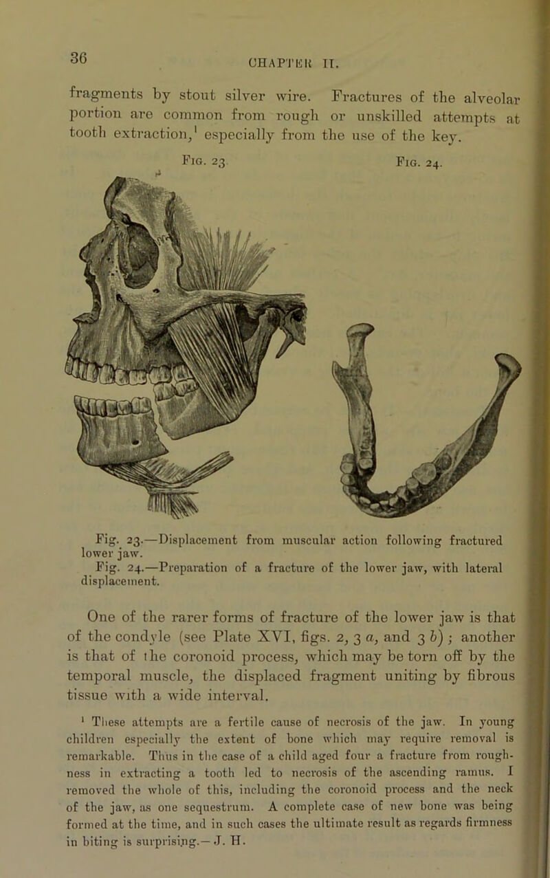 OH APT IS It II. fragments by stout silver wire. Fractures of the alveolar portion are common from rough or unskilled attempts at tooth extraction/ esjaecially from the use of the key. Fig. 23 Pig. 24. Fig. 23.—Displacement from muscular action following fractured lower jaw. Fig. 24.—Preparation of a fracture of the lower jaw, with lateral displacement. One of the rarer forms of fracture of the lower jaw is that of the condyle (see Plate XVI, figs. 2, 3 a, and 3 b') ; another is that of the coronoid process, which may be torn off by the temporal muscle, the displaced fragment uniting by fibrous tissue with a wide interval. 1 These attempts are a fertile cause of necrosis of the jaw. In young children especially the extent of bone which may require removal is remarkable. Thus in the case of a child aged four a fracture from rough- ness in extracting a tooth led to necrosis of the ascending ramus. I removed the whole of this, including the coronoid process and the neck of the jaw, as one sequestrum. A complete case of new bone was being formed at tbe time, and in such cases the ultimate result as regards firmness in biting is surprising.—J. II.