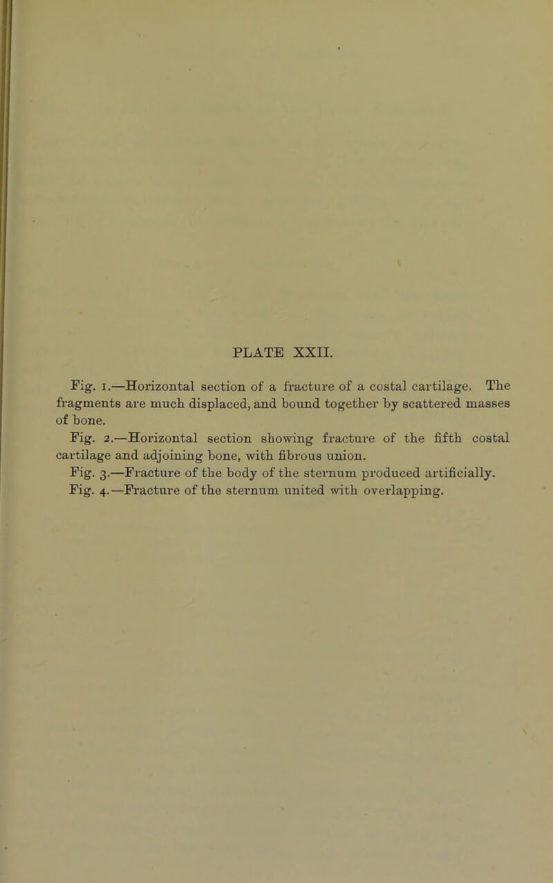 Pig. i.—Horizontal section of a fracture of a costal cartilage. The fragments are much displaced, and bound together by scattered masses of bone. Fig. 2.—Horizontal section showing fracture of the fifth costal cartilage and adjoining bone, with fibrous union. Fig. 3.—Fracture of the body of the sternum produced artificially. Fig. 4.—Fracture of the sternum united with overlapping.