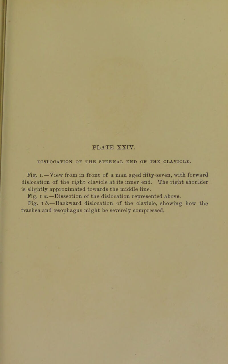 DISLOCATION OP THE STEENAL END OP THE CLAVICLE. Fig. i.—View from in front of a man aged fifty-seven, with forward dislocation of the right clavicle at its inner end. The right shoulder is slightly approximated towards the middle line. Fig. i a.—Dissection of the dislocation represented above. Fig. i b.—Backwai-d dislocation of the clavicle, showing how the trachea and oesophagus might be severely compressed.