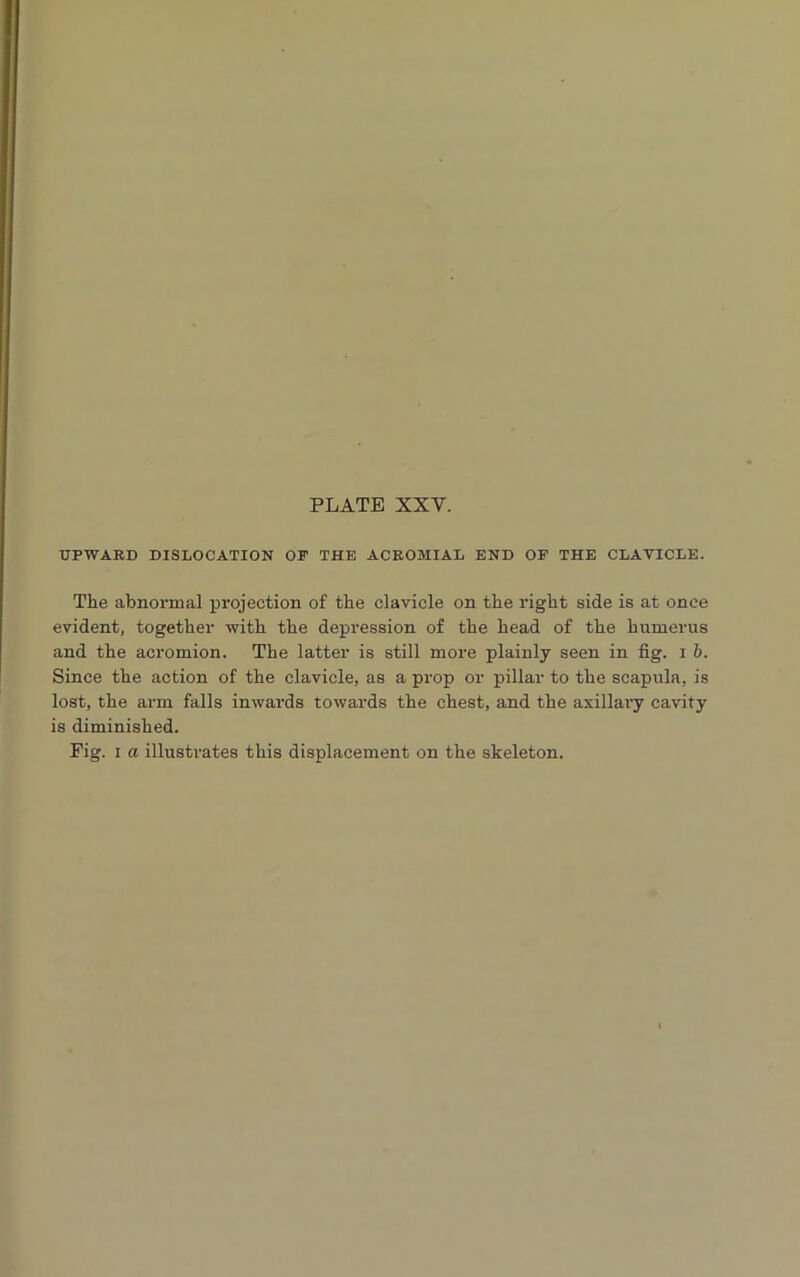 UPWARD DISLOCATION OP THE ACROMIAL END OF THE CLAVICLE. The abnormal projection of the clavicle on the right side is at once evident, together with the depression of the head of the humerus and the acromion. The latter is still more plainly seen in fig. i b. Since the action of the clavicle, as a prop or pillar to the scapula, is lost, the arm falls inwards towards the chest, and the axillary cavity is diminished. Fig. i a illustrates this displacement on the skeleton.