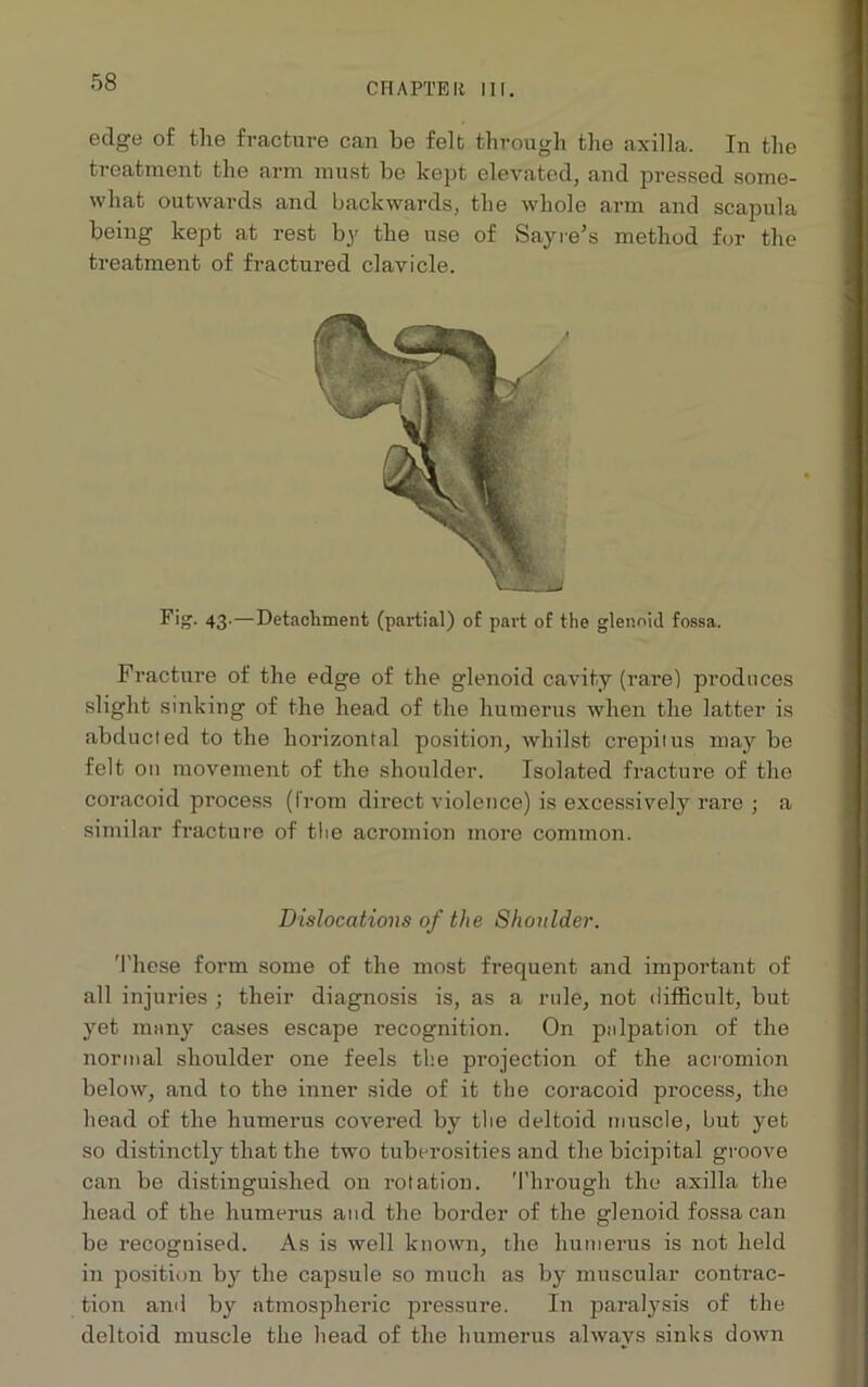 edge of the fracture can be felt through the axilla. In the treatment the arm must be kept elevated, and pressed some- what outwards and backwards, the whole arm and scapula being kept at rest by the use of Sayre’s method for the treatment of fractured clavicle. Fig. 43.—Detachment (partial) of part of the glenoid fossa. Fracture of the edge of the glenoid cavity (rare) produces slight sinking of the head of the humerus when the latter is abducted to the horizontal position, whilst crepitus may be felt on movement of the shoulder. Isolated fracture of the coracoid process (from direct violence) is excessively rare ; a similar fracture of the acromion more common. Dislocations of the Shoulder. These form some of the most frequent and important of all injuries ; their diagnosis is, as a ride, not difficult, but yet many cases escape recognition. On palpation of the normal shoulder one feels the projection of the acromion below, and to the inner side of it the coracoid process, the head of the humerus covered by the deltoid muscle, but yet so distinctly that the two tuberosities and the bicipital groove can be distinguished on rotation. Through the axilla the head of the humerus and the border of the glenoid fossa can be recognised. As is well known, the humerus is not held in position by the capsule so much as by muscular contrac- tion and by atmospheric pressure. In paralysis of the deltoid muscle the head of the humerus always sinks down