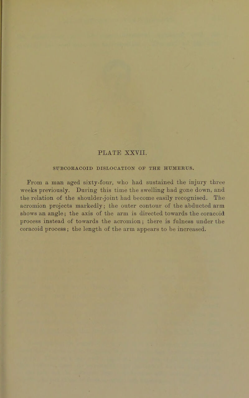 SUBCORACOID DISLOCATION OF THE HUMERUS. From a man aged sixty-four, who had sustained the injury three weeks previously. During this time the swelling had gone down, and the relation of the shoulder-joint had become easily recognised. The acromion projects markedly; the outer contour of the abducted arm shows an angle; the axis of the arm is directed towards the coracoid process instead of towards the acromion; there is fulness under the coracoid process; the length of the arm appears to be increased.