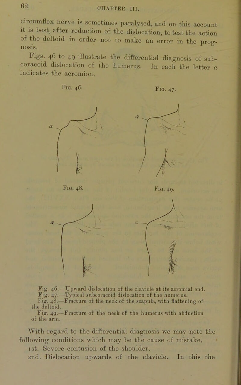 CHAPTER III. circumflex nerve is sometimes paralysed, and on this account it is best, after reduction of the dislocation, to test the action of the deltoid in order not to make an error in the prog- nosis. Figs. 46 to 4Q illustrate the differential diagnosis of sub- coracoid dislocation of the humerus. In each the letter a indicates the acromion. Fig. 46- Fig. 47. Fig. 46.—-Upward dislocation of the clavicle at its acromial end. Fig. 47.—Typical snbcoracoid dislocation of the humerus. Fig. 48.—Fracture of the neck of the scapula, with flattening of the deltoid. Fig. 49.—Fracture of the neck of the humerus with abduction of the arm. With regard to the differential diagnosis we may note the following conditions which may be the cause of mistake. 1st. Severe contusion of the shoulder. 2nd. Dislocation upwards of the clavicle. In this the