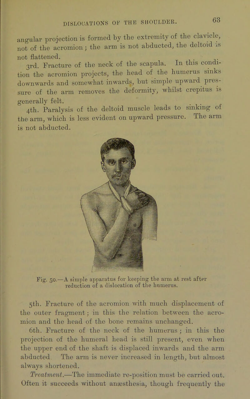 DISLOCATIONS Ob’ THE SHOULDER. angular projection is formed by the extremity of the clavicle, not of the acromion j the arm is not abducted, the deltoid vs not flattened. 3rd. Fracture of the neck of the scapula. In this condi- tion the acromion projects, the head of the humerus sinks downwards and somewhat inwards, but simple upward pres- sure of the arm removes the deformity, whilst crepitus is generally felt. 4th. Paralysis of the deltoid muscle leads to sinking of the arm, which is less evident on upward pressure. The aim is not abducted. Fig. 50.—A simple apparatus for keeping the arm at rest after reduction of a dislocation of the humerus. 5th. Fracture of the acromion with much displacement of the outer fragment; in this the relation between the acro- mion and the head of the bone remains unchanged. 6tli. Fracture of the neck of the humerus ; in this the projection of the humeral head is still present, even when the upper end of the shaft is displaced inwards and the arm abducted The arm is never increased in length, but almost always shortened. Treatment.—The immediate re-position must be carried out. Often it succeeds without anaesthesia, though frequently the