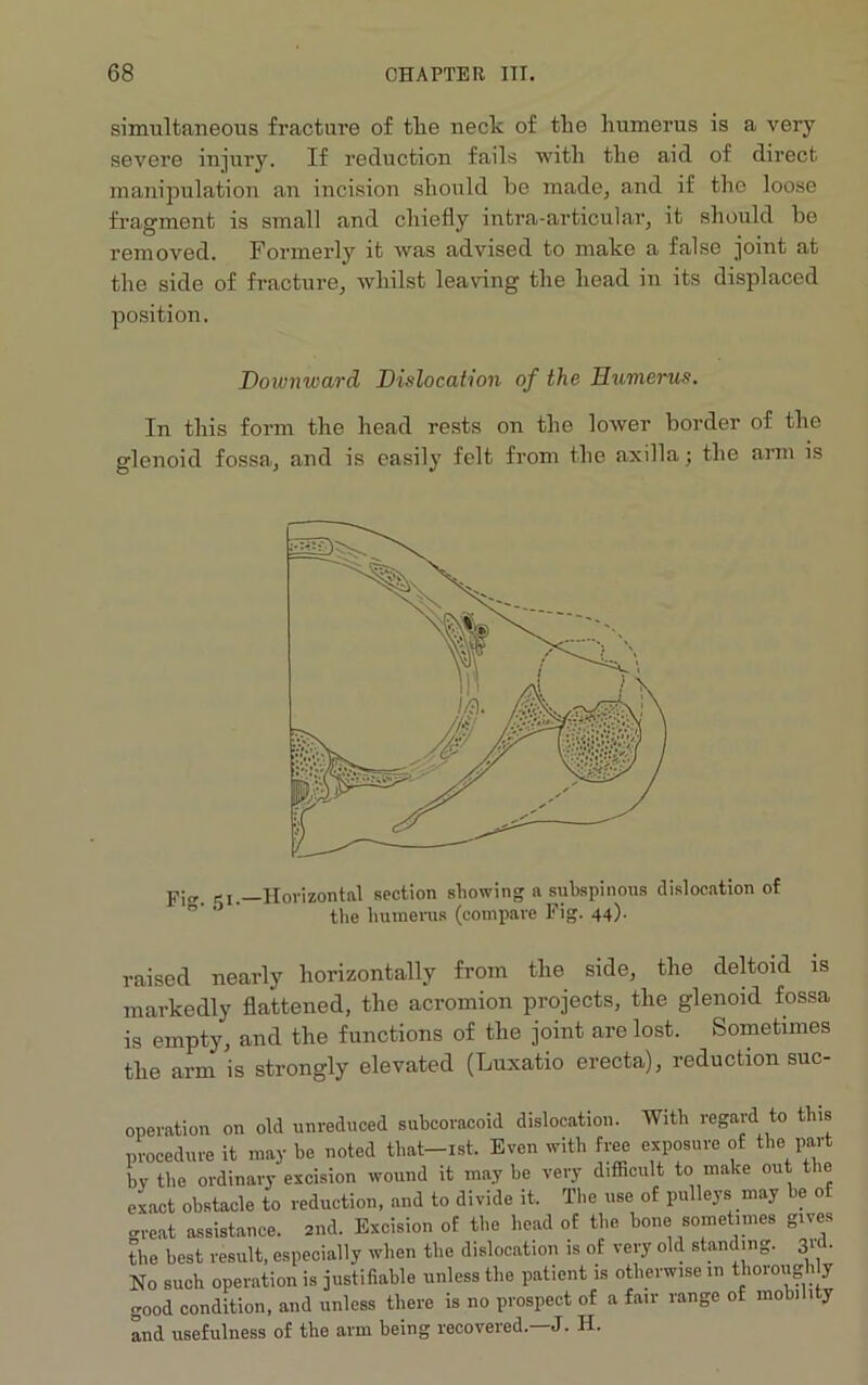 simultaneous fracture of tlie neck of tlie humerus is a very severe injury. If reduction fails with the aid of direct manipulation an incision should be made, and if the loose fragment is small and chiefly intra-articular, it should be removed. Formerly it was advised to make a false joint at the side of fracture, whilst leaving the head in its displaced position. Downward Dislocation of the Humerus. In this form the head rests on the lower border of the glenoid fossa, and is easily felt from the axilla; the arm is pj„. r i.—Horizontal section showing a subspinous dislocation of the humerus (compare Fig. 44). raised nearly horizontally from the side, the deltoid is markedly flattened, the acromion projects, the glenoid fossa is empty, and the functions of the joint are lost. Sometimes the arm is strongly elevated (Luxatio erecta), reduction suc- operation on old unreduced subcoracoid dislocation. With regard to this procedure it may be noted that-ist. Even with free exposure of the part by the ordinary excision wound it may he very difficult to make out the exact obstacle to reduction, and to divide it. The use of pulleys may be of great assistance. 2nd. Excision of the head of the bone sometimes gives the best result, especially when the dislocation is of very old standing. 31 • No such operation is justifiable unless the patient is otherwise in thoroughly good condition, and unless there is no prospect of a fair range of mobi 1 y and usefulness of the arm being recovered.—J. H.