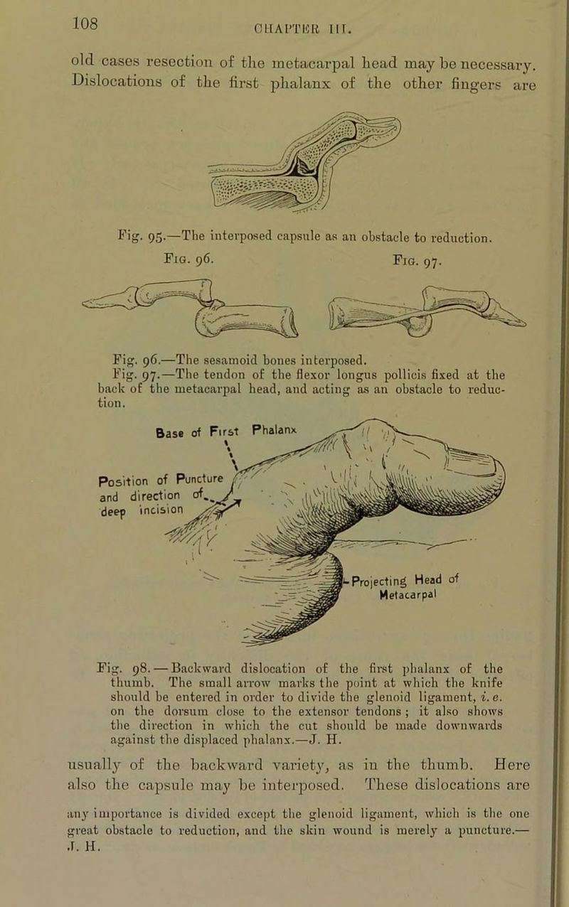 oriAi’Tiiii iir. old cases resection of the metacarpal head may be necessary. Dislocations of the first phalanx of the other fingers are Fig. 95.—The interposed capsule as an obstacle to reduction. Fig. 96. Fig. 97. Fig. 96.—The sesamoid bones interposed. Fig. 97.—The tendon of the flexor longus pollieis fixed at the back of the metacarpal head, and acting as an obstacle to reduc- tion. Fig. 98. — Backward dislocation of the first phalanx of the thumb. The small arrow marks the point at which the knife should be entered in order to divide the glenoid ligament, i. e. on the dorsum close to the extensor tendons ; it also shows the direction in which the cut should be made downwards against the displaced phalanx.—J. H. usually of tlie backward variety, as in the thumb. Here also the capsule may be interposed. These dislocations are an}' importance is divided except the glenoid ligament, which is the one great obstacle to reduction, and the skin wound is merely a puncture.— .1. H.