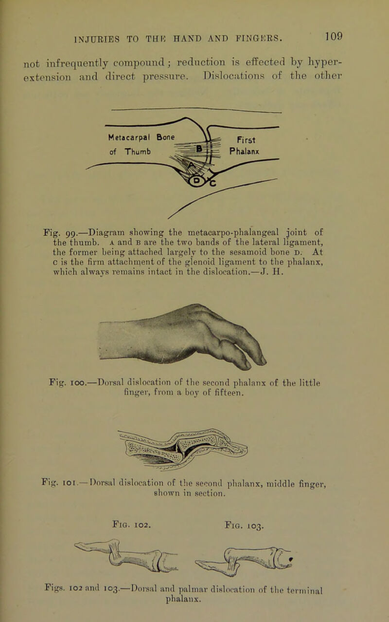 not infrequently compound; reduction is effected by hyper- extension and direct pressure. Dislocations of the other Pig. 99.—Diagram showing the metacarpo-phalangeal joint of the thumb. A and b are the two hands of the lateral ligament, the former being attached largely to the sesamoid bone D. At c is the firm attachment of the glenoid ligament to the phalanx, which always remains intact in the dislocation.—J. H. Fig. 100.—Dorsal dislocation of the second phalanx of the little finger, from a boy of fifteen. Fig. 101.— Dorsal dislocation of the second phalanx, middle finger, shown in section. Fig. 102. Fig. 103. Figs. 102 and 103.—Dorsal and palmar dislocation of the terminal phalanx.