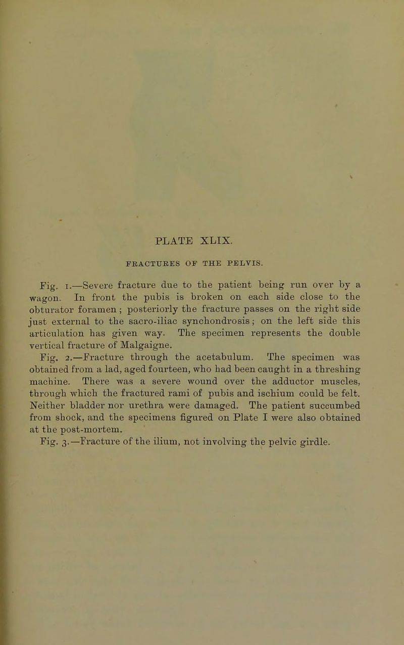 PLATE XLIX. FRACTURES OF THE PELVIS. Pig. i.—Severe fracture due to the patient being run over by a wagon. In front the pubis is broken on eacb side close to the obturator foramen; posteriorly tbe fracture passes on the right side just external to tbe sacro-iliac synchondrosis; on tbe left side this articulation has given way. The specimen represents tbe double vertical fracture of Malgaigne. Fig. 2.—Fracture through the acetabulum. The specimen was obtained from a lad, aged fourteen, who had been caught in a threshing machine. There was a severe wound over the adductor muscles, through which the fractured rami of pubis and ischium could be felt. Neither bladder nor urethra were damaged. The patient succumbed from shock, and the specimens figured on Plate I were also obtained at the post-mortem. Fig. 3.—Fracture of the ilium, not involving the pelvic girdle.