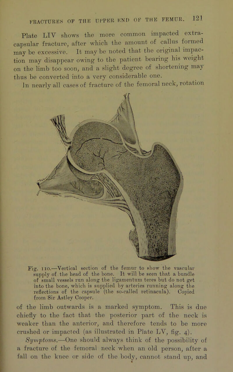 Plate LIV shows the more common Impacted extra- capsular fracture, after which the amount of callus formed may be excessive. It may be noted that the original impac- tion may disappear owing to the patient bearing his weight on the limb too soon, and a slight degree of shortening may thus be converted into a very considerable one. In nearly all cases of fracture of the femoral neck, rotation Fig. no.—Vertical section of the femur to show the vascular supply of the head of the bone. It will be seen that a bundle of small vessels run along the ligamentum teres but do not get into the bone, which is supplied by arteries running along the reflections of the capsule (the so-called retinacula). Copied from Sir Astley Cooper. of the limb outwards is a marked symptom. This is due chiefly to the fact that the posterior part of the neck is weaker than the anterior, and therefore tends to be more crushed or impacted (as illustrated in Plate LV, fig. 4). Symptoms.—One should always think of the possibility of a fracture of the femoral neck when an old person, after a fall on the knee or side of the body, cannot stand up, and