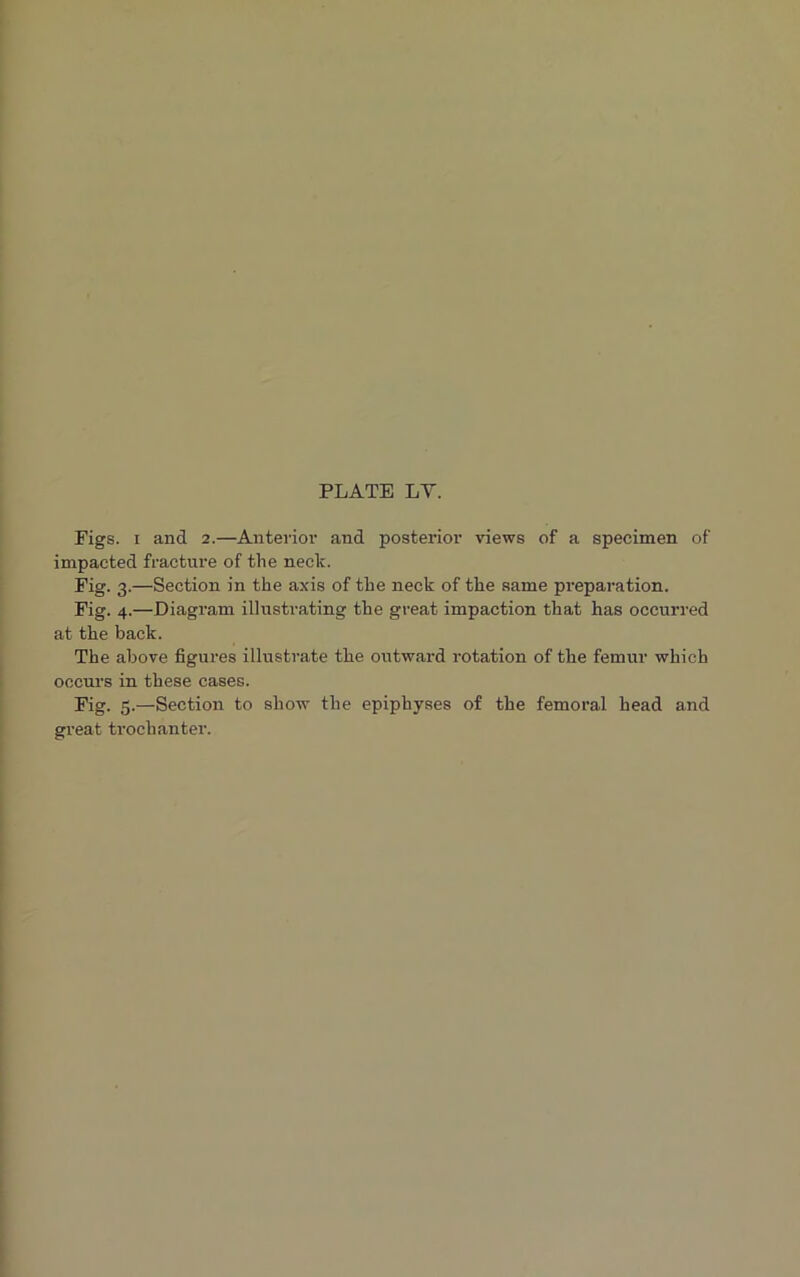 Figs, i and 2.—Anterior and posterior views of a specimen of impacted fracture of the neclc. Fig. 3.—Section in the axis of the neck of the same preparation. Fig. 4.—Diagram illustrating the great impaction that has occurred at the back. The above figures illustrate the outward rotation of the femur which occurs in these cases. Fig. 5.—Section to show the epiphyses of the femoral head and great trochanter.