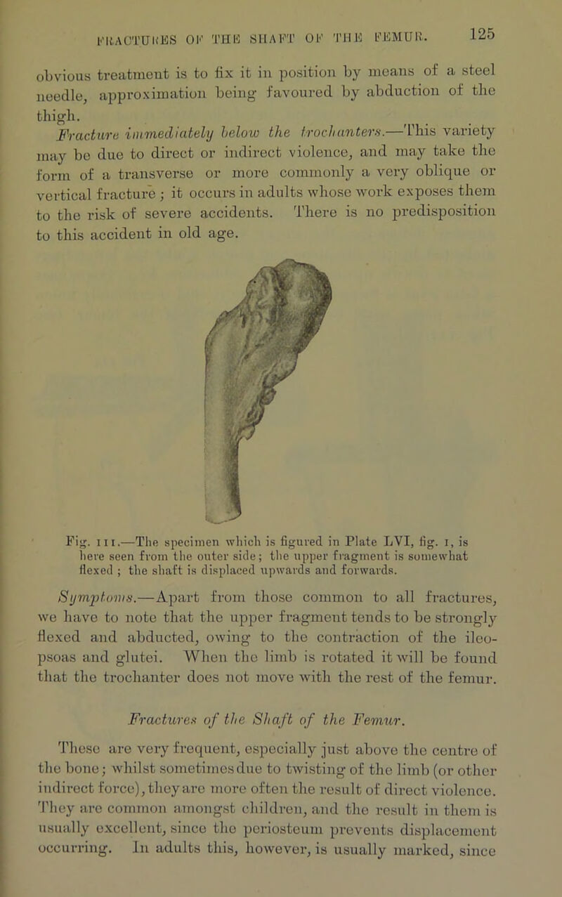obvious treatment is to fix it in position by means of a steel needle, approximation being favoured by abduction of the thigh. Fracture immediately below the trochanters.—'This variety may be due to direct or indirect violence, and may take the form of a transverse or more commonly a very oblique or vertical fracture ; it occurs in adults whose work exposes them to the risk of severe accidents. There is no predisposition to this accident in old age. Pig. hi.—The specimen which is figured in Plate LVI, fig. i, is here seen from the outer side; the upper fragment is somewhat flexed ; the shaft is displaced upwards and forwards. Symptoms.—Apart from those common to all fractures, we have to note that the upper fragment tends to be strongly flexed and abducted, owing to the contraction of the ileo- psoas and glutei. When the limb is rotated it will be found that the trochanter does not move with the rest of the femur. Fractures of the Shaft of the Femur. These are very frequent, especially just above the centre of the bone; whilst sometimes due to twisting of the limb (or other indirect force), they arc more often the result of direct violence. They are common amongst children, and the result in them is usually excellent, since the periosteum prevents displacement occurring. In adults this, however, is usually marked, since