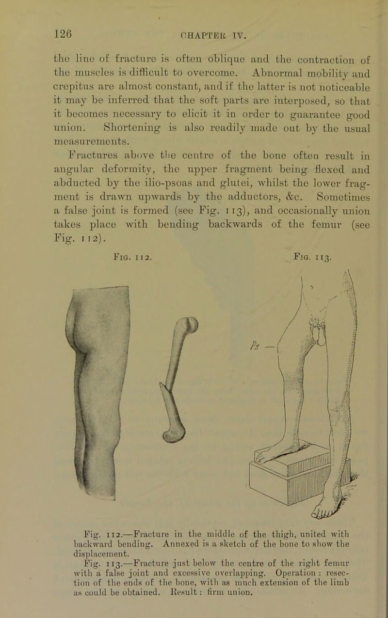 the line of fracture is often oblique and the contraction of the muscles is difficult to overcome. Abnormal mobility and crepitus are almost constant, and if the latter is not noticeable it may be inferred that the soft parts are interposed, so that it becomes necessary to elicit it in order to guarantee good union. Shortening is also readily made out by the usual measurements. Fractures above the centre of the bone often result in angular deformity, the upper fragment being flexed and abducted by the ilio-psoas and glutei, whilst the lower frag- ment is drawn upwards by the adductors, &c. Sometimes a false joint is formed (see Fig. i 13), and occasionally union takes place with bending backwards of the femur (see Fig. 112). Fig. 112. Fig. 113. Fig. 112.—Fracture in the middle of the thigh, united with backward bending. Annexed is a sketch of the bone to show the displacement. Fig. 113.—Fracture just below the centre of the right femur with a false joint and excessive overlapping. Operation : resec- tion of the ends of the hone, with as much extension of the limb as could be obtained. Result: firm union.