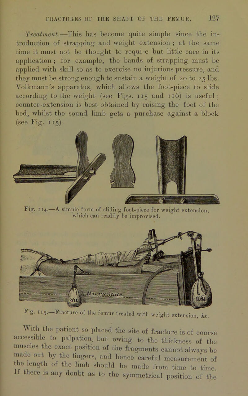Treatment.—This has become quite simple since the in- troduction of strapping- and weight extension ; at the same time it must not be thought to require but little care in its application; for example, the bands of strapping must be applied with skill so as to exercise no injurious pressure, and they must be strong enough to sustain a weight of 20 to 25 lbs. Volkmann’s apparatus, which allows the foot-piece to slide according to the weight (see Figs. 115 and 116) is useful ; counter-extension is best obtained by raising the foot of the bed, whilst the sound limb gets a purchase against a block (see Fig. 115). Fig. 114.—A simple form of sliding foot-piece for weight extension, which can readily he improvised. With the patient so placed the site of fracture is of course accessible to palpation, but owing to the thickness of the muscles the exact position of the fragments cannot always be made out by the fingers, and hence careful measurement of he ength of the limb should be made from time to time, there is any doubt as to the symmetrical position of the
