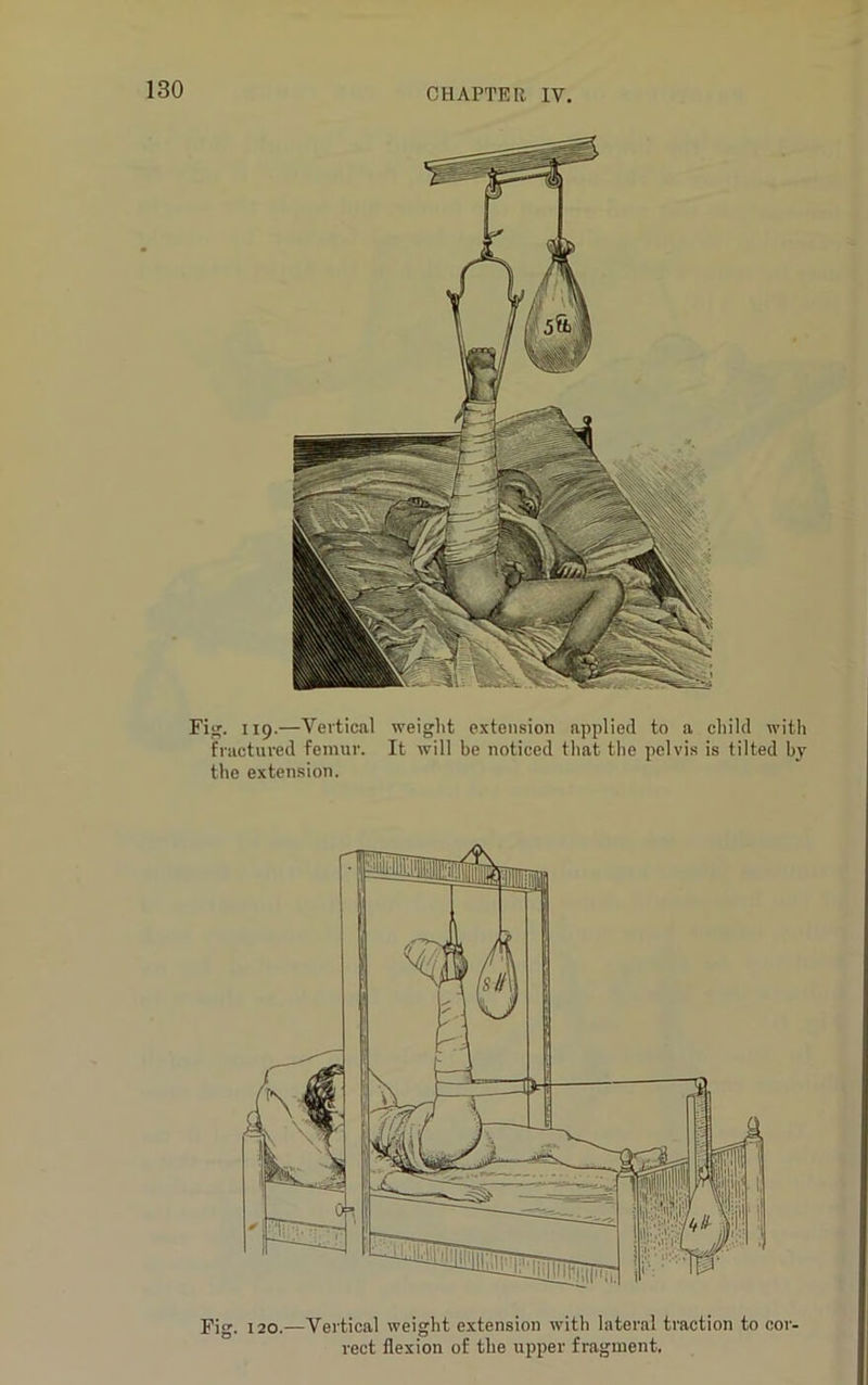 Fig. 119.—Vertical weight extension applied to a child with fractured femur. It will be noticed that the pelvis is tilted by the extension. Fig. 120.—Vertical weight extension with lateral traction to cor- rect flexion of the upper fragment.