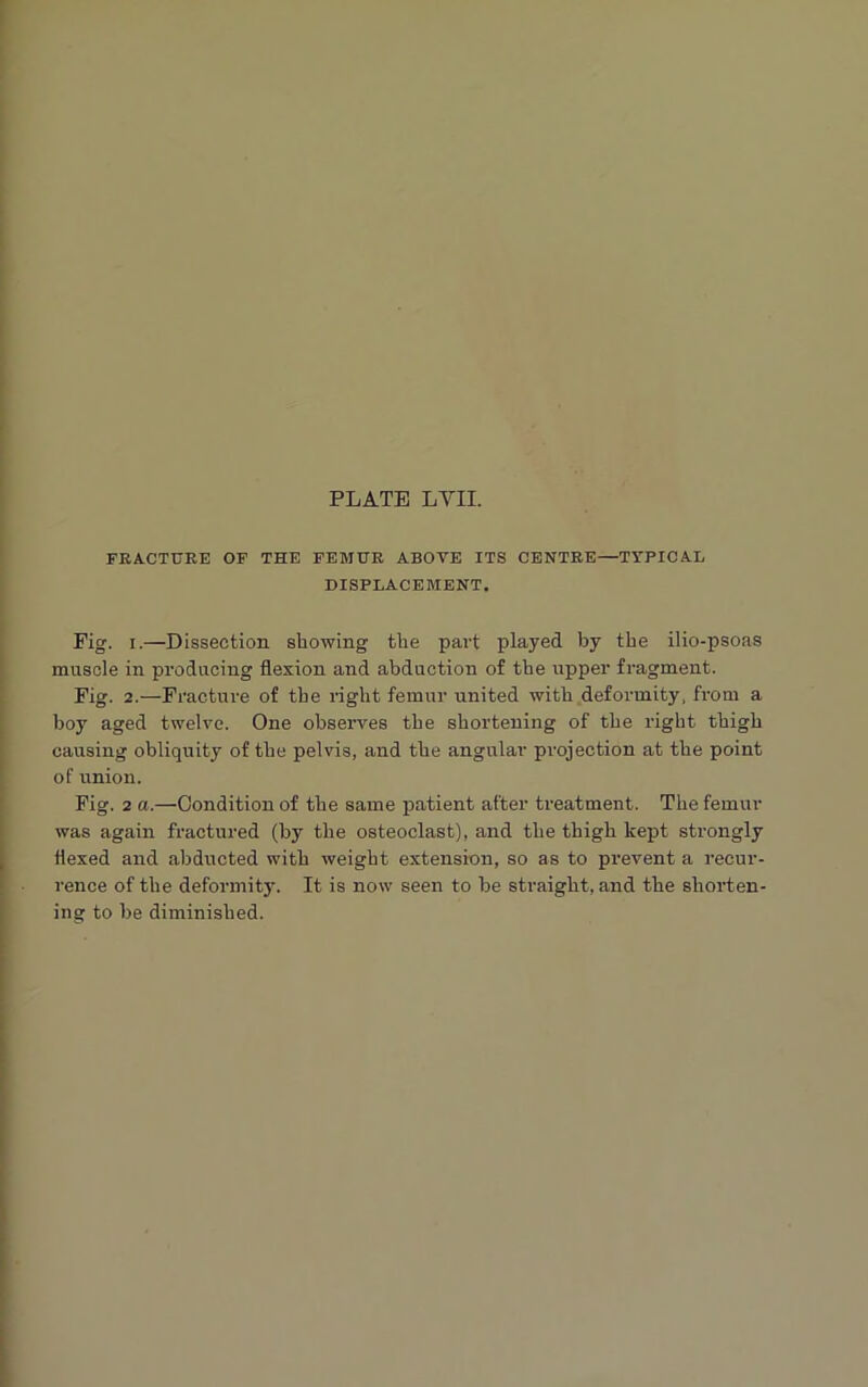 FRACTURE OF THE FEMUR ABOVE ITS CENTRE—TYPICAL DISPLACEMENT. Fig. i.—Dissection showing the part played by the ilio-psoas muscle in producing flexion and abduction of the upper fragment. Fig. 2.—Fracture of the right femur united with deformity, from a boy aged twelve. One observes the shortening of the right thigh causing obliquity of the pelvis, and the angular projection at the point of union. Fig. 2 a.—Condition of the same patient after treatment. The femur was again fractured (by the osteoclast), and the thigh kept strongly flexed and abducted with weight extension, so as to pi-event a recur- rence of the deformity. It is now seen to he straight, and the shorten- ing to he diminished.