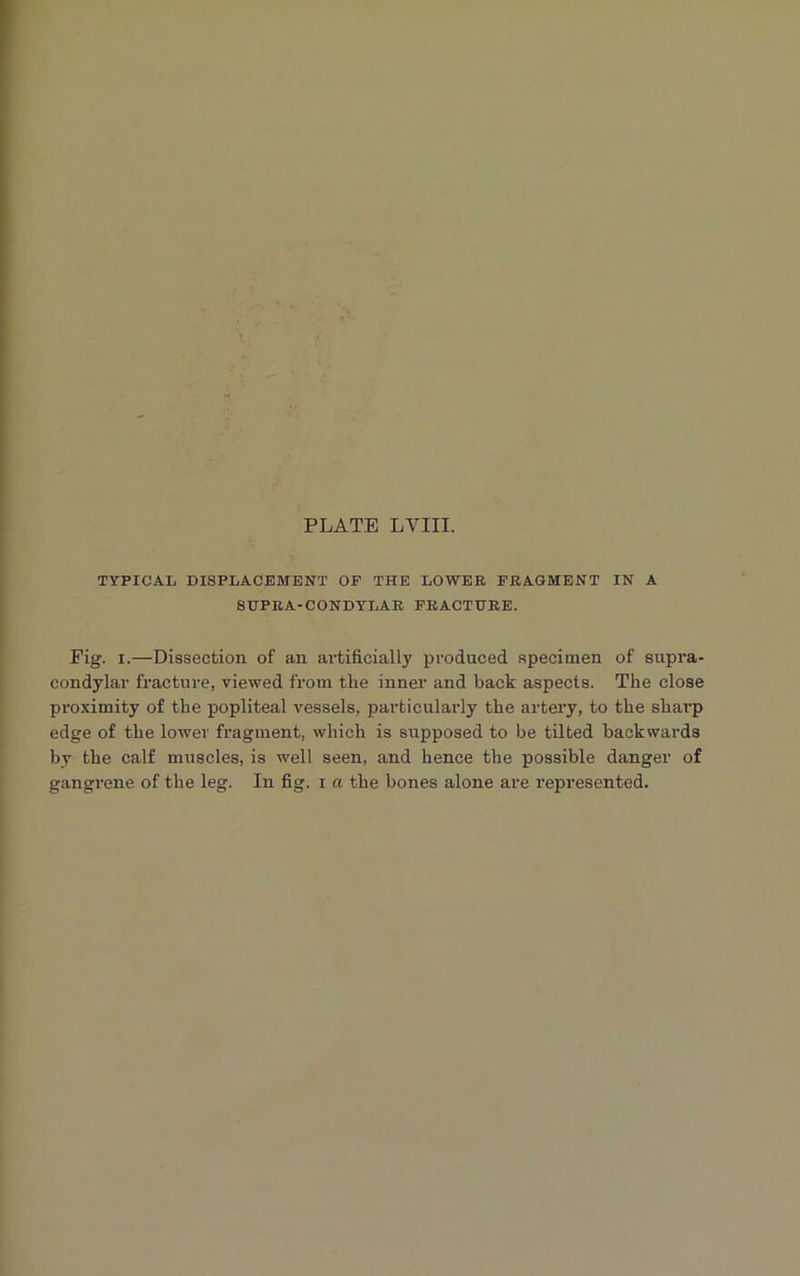 TYPICAL DISPLACEMENT OF THE LOWER FRAGMENT IN A SUPRA-CONDYLAR FRACTURE. Fig. i.—Dissection of an artificially produced specimen of supra- condylar fracture, viewed from the inner and back aspects. The close proximity of the popliteal vessels, particularly the artery, to the sharp edge of the lower fragment, which is supposed to be tilted backwards by the calf muscles, is well seen, and hence the possible danger of