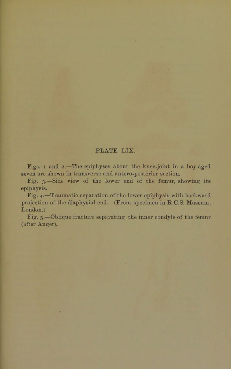Figs, i and 2.—The epiphyses about the knee-joint in a boy aged seven are shown in transverse and antero-posterior section. Fig- 3 .—Side view of the lower end of the femur, showing its epiphysis. Fig. 4.—Traumatic separation of the lower epiphysis with backward projection of the diaphysial end. (From specimen in R.C.S. Museum, London.) Fig. 5.—Oblique fracture separating the inner condyle of the femur (after Anger).
