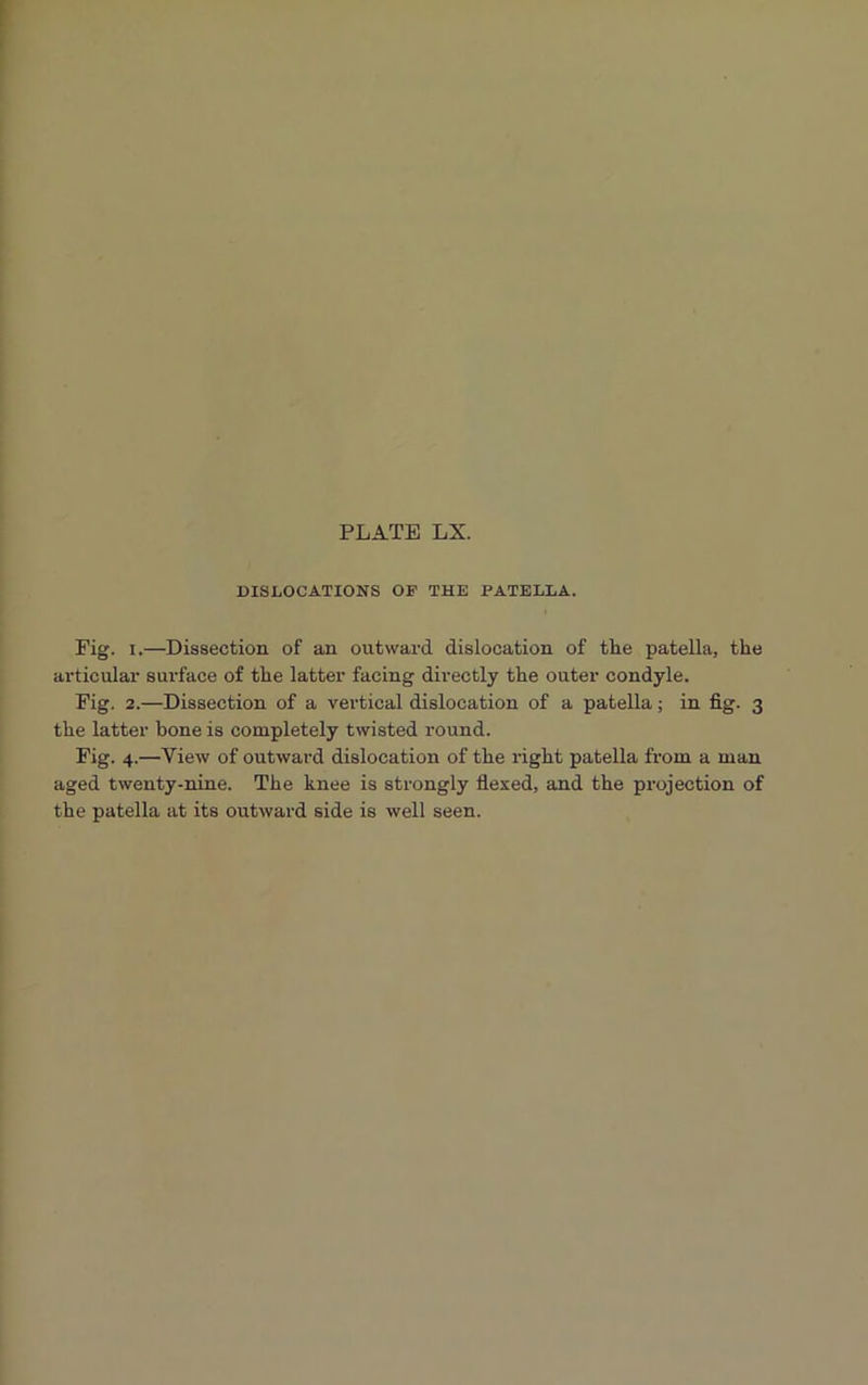 DISLOCATIONS OF THE PATELLA. Fig. i.—Dissection of an outward dislocation of the patella, the articular surface of the latter facing directly the outer condyle. Fig. 2.—Dissection of a vertical dislocation of a patella; in fig. 3 the latter bone is completely twisted round. Fig. 4.—View of outward dislocation of the right patella from a man aged twenty-nine. The knee is strongly flexed, and the projection of the patella at its outward side is well seen.