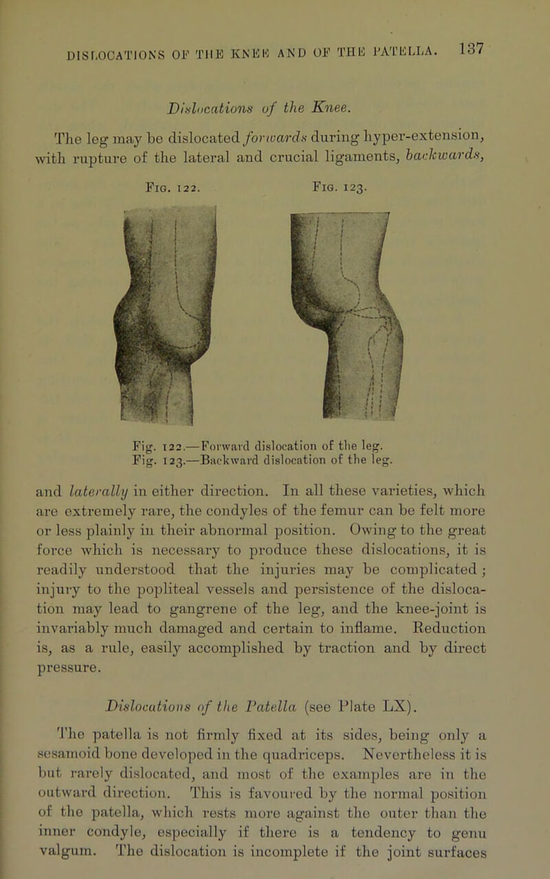 DISLOCATIONS OF THE KNEE AND OF THE PATELLA. Dislocations of the Knee. The leg may be dislocated forwards during hyper-extension, with rupture of the lateral and crucial ligaments, backwards, Fig. 122. Fig. 123. Fig. 122.—Forward dislocation of the leg. Fig. 123.—Backward dislocation of the leg. and laterally in either direction. In all these varieties, which are extremely rare, the condyles of the femur can be felt more or less plainly in their abnormal position. Owing to the great force which is necessary to produce these dislocations, it is readily understood that the injuries may be complicated; injury to the popliteal vessels and persistence of the disloca- tion may lead to gangrene of the leg, and the knee-joint is invariably much damaged and certain to inflame. Reduction is, as a rule, easily accomplished by traction and by direct pressure. Dislocations of the Patella (see Plate LX). The patella is not firmly fixed at its sides, being only a sesamoid bone developed in the quadriceps. Nevertheless it is but rarely dislocated, and most of the examples are in the outward direction. This is favoured by the normal position of the patella, which rests more against the outer than the inner condyle, especially if there is a tendency to genu valgum. The dislocation is incomplete if the joint surfaces