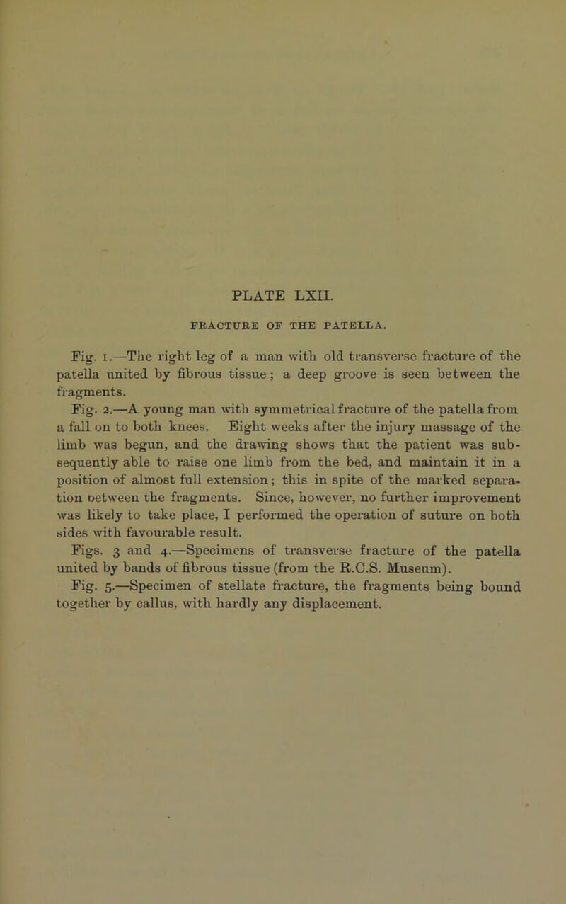 FRACTURE OF THE PATELLA. Pig. i.—The right leg of a man with old transverse fracture of the patella united by fibrous tissue; a deep groove is seen between the fragments. Fig. 2.—A young man with symmetrical fracture of the patella from a fall on to both knees. Eight weeks after the injury massage of the limb was begun, and the drawing shows that the patient was sub- sequently able to raise one limb from the bed, and maintain it in a position of almost full extension; this in spite of the marked separa- tion oetween the fragments. Since, however, no further improvement was likely to take place, I performed the operation of suture on both sides with favourable result. Figs. 3 and 4.—Specimens of transverse fracture of the patella united by bands of fibrous tissue (from the R.C.S. Museum). Fig. 5.—Specimen of stellate fracture, the fragments being bound together by callus, with hardly any displacement.