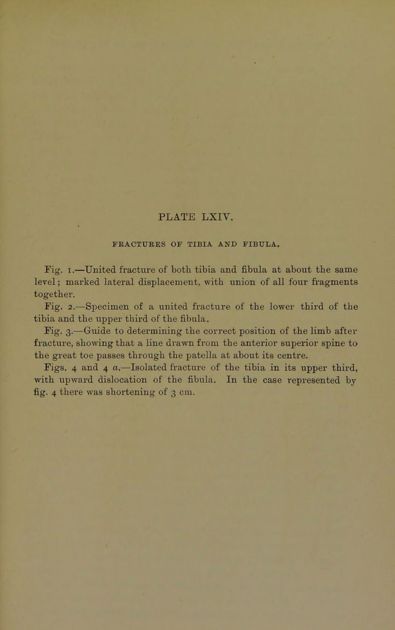 FRACTURES OF TIBIA AND FIBULA. Pig. i.—United fracture of both tibia and fibula at about the same level; marked lateral displacement, with union of all four fragments together. Fig. 2.—Specimen of a united fracture of the lower third of the tibia and the upper third of the fibula. Fig. 3.—Guide to determining the correct position of the limb after fracture, showing that a line drawn from the anterior superior spine to the great toe passes through the patella at about its centre. Figs. 4 and 4 a.—Isolated fracture of the tibia in its upper third, with upward dislocation of the fibula. In the case represented by fig. 4 there was shortening of 3 cm.