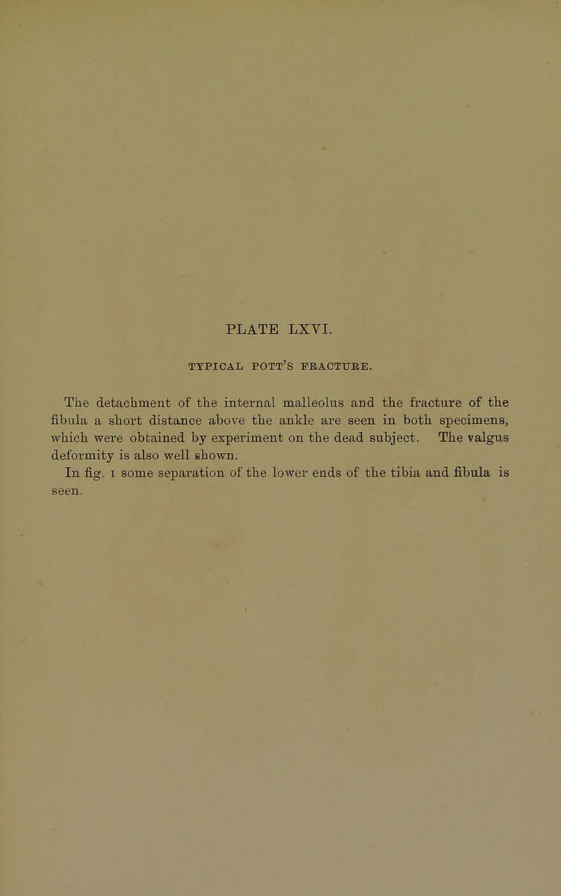 TYPICAL POTT’S FRACTURE. The detachment of the internal malleolus and the fracture of the fibula a short distance above the ankle are seen in both specimens, which were obtained by experiment on the dead subject. The valgus deformity is also well shown. In fig. i some separation of the lower ends of the tibia and fibula is seen.