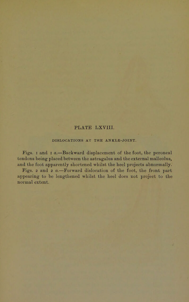 PLATE LXYIII. DISLOCATIONS AT THE ANKLE-JOINT. Pigs, i and i a.—Backward displacement of the foot, the peroneal tendons being placed between the astragalus and the external malleolus, and the foot apparently shortened whilst the heel projects abnormally. Figs. 2 and 2 a.—Forward dislocation of the foot, the front part appearing to be lengthened whilst the heel does not project to the normal extent.