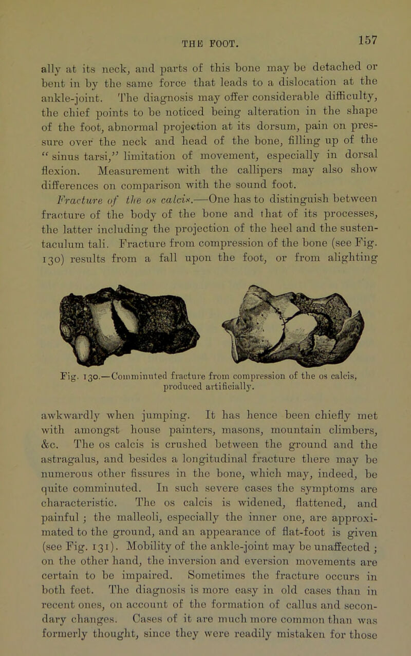 ally at its neck, and parts of this bone may be detached or bent in by the same force that leads to a dislocation at the ankle-joint. The diagnosis may offer considerable difficulty, the chief points to be noticed being alteration in the shape of the foot, abnormal projection at its dorsum, pain on pres- sure over the neck and head of the bone, filling up of the “ sinus tarsi/5 limitation of movement, especially in dorsal flexion. Measurement with the callipers may also show differences on comparison with the sound foot. Fracture of the on calci*.—One has to distinguish between fracture of the body of the bone and that of its processes, the latter including the projection of the heel and the susten- taculum tali. Fracture from compression of the bone (see Fig. 130) results from a fall upon the foot, or from alighting Fig. 130.—Comminuted fracture from compression of the os caleis, produced artificially. awkwardly when jumping. It has hence been chiefly met with amongst house painters, masons, mountain climbers, &c. The os calcis is crushed between the ground and the astragalus, and besides a longitudinal fracture there may be numerous other fissures in the bone, which may, indeed, be quite comminuted. In such severe cases the symptoms are characteristic. The os calcis is widened, flattened, and painful ; the malleoli, especially the inner one, are approxi- mated to the ground, and an appearance of flat-foot is given (see Fig. 131). Mobility of the ankle-joint may be unaffected ; on the other hand, the inversion and eversion movements are certain to be impaired. Sometimes the fracture occurs in both feet. The diagnosis is more easy in old cases than in recent ones, on account of the formation of callus and secon- dary changes. Cases of it are much more common than was formerly thought, since they were readily mistaken for those