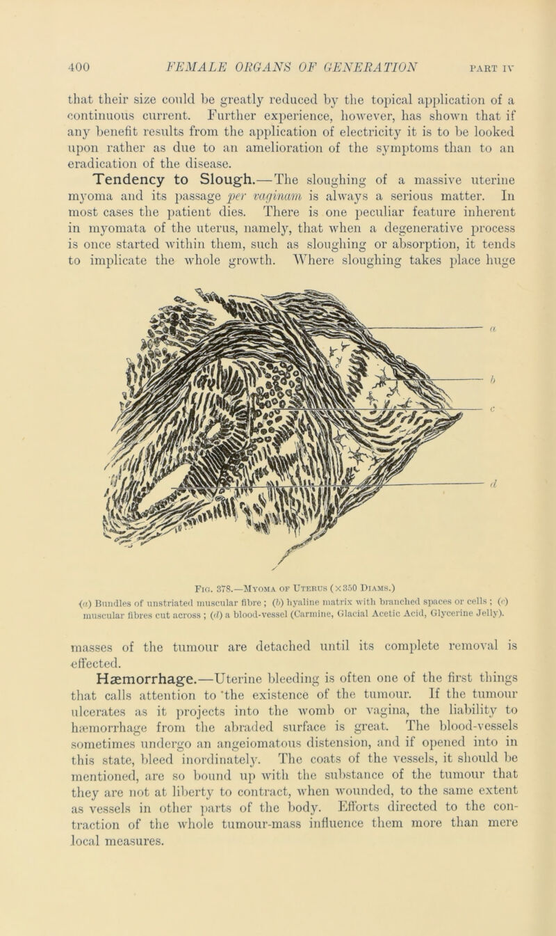 that their size could lie greatly reduced by the topical application of a continuous current. Further experience, however, has shown that if any benefit results from the application of electricity it is to be looked upon rather as due to an amelioration of the symptoms than to an eradication of the disease. Tendency to Slough.—The sloughing of a massive uterine myoma and its passage per vaginam is always a serious matter. In most cases the patient dies. There is one peculiar feature inherent in myomata of the uterus, namely, that when a degenerative process is once started within them, such as sloughing or absorption, it tends to implicate the whole growth. Where sloughing takes place huge a b d Fig. 378.—Myoma of Uterus (x350 Diams.) (a) Bundles of unstriated muscular fibre ; (h) hyaline matrix with branched spaces or cells ; (c) muscular fibres cut across ; (<l) a blood-vessel (Carmine, Glacial Acetic Acid, Glycerine Jelly). masses of the tumour are detached until its complete removal is effected. Haemorrhage.—Uterine bleeding is often one of the first things that calls attention to 'the existence of the tumour. If the tumour ulcerates as it projects into the womb or vagina, the liability to haemorrhage from the abraded surface is great. The blood-vessels sometimes undergo an angeiomatous distension, and if opened into in this state, bleed inordinately. The coats of the vessels, it should be mentioned, are so bound up with the substance of the tumour that they are not at liberty to contract, when wounded, to the same extent as vessels in other parts of the body. Efforts directed to the con- traction of the whole tumour-mass influence them more than mere local measures.