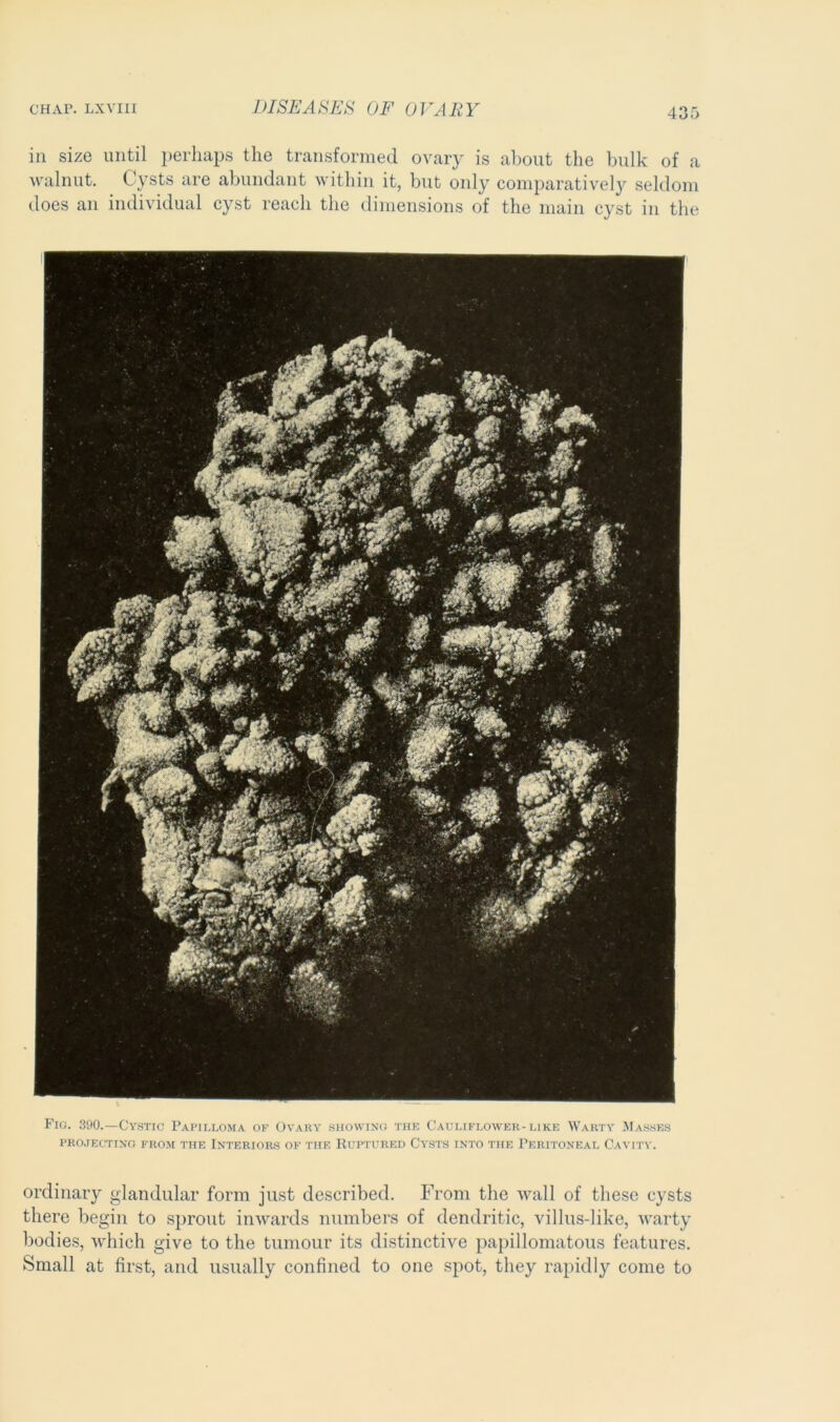 in size until perhaps the transformed ovary is about the bulk of a walnut. Cysts are abundant within it, but only comparatively seldom does an individual cyst reach the dimensions of the main cyst in the Fio. 390.—Cystic Papilloma of Ovary showing the Cauliflower-like Warty Masses PROJECTING FROM THE INTERIORS OF THE RUPTURED CYSTS INTO THE PERITONEAL CAVITY. ordinary glandular form just described. From the wall of these cysts there begin to sprout inwards numbers of dendritic, villus-like, warty bodies, which give to the tumour its distinctive papillomatous features. Small at first, and usually confined to one spot, they rapidly come to