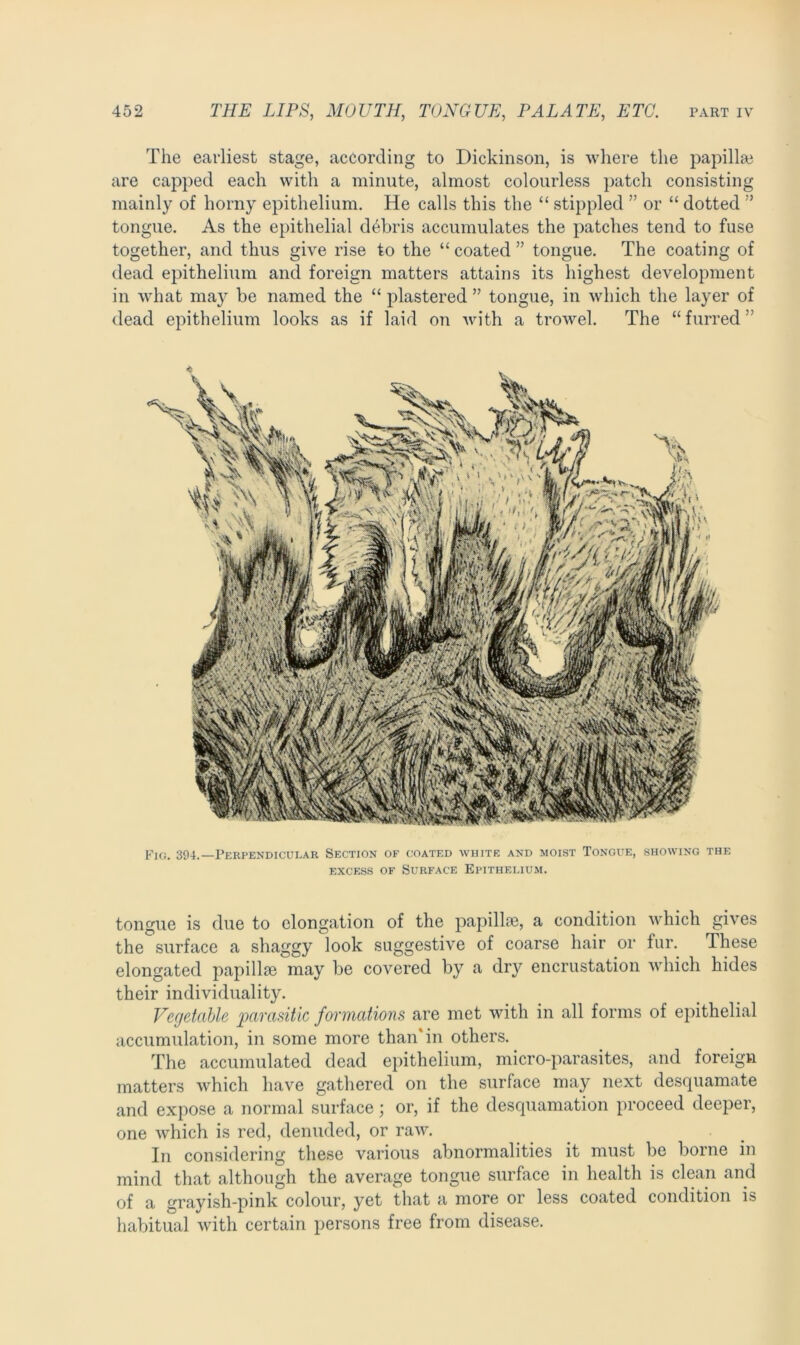 The earliest stage, according to Dickinson, is where the papilla} are capped each with a minute, almost colourless patch consisting mainly of horny epithelium. He calls this the “ stippled ” or “ dotted ” tongue. As the epithelial debris accumulates the patches tend to fuse together, and thus give rise to the “ coated ” tongue. The coating of dead epithelium and foreign matters attains its highest development in what may be named the “ plastered ” tongue, in which the layer of dead epithelium looks as if laid on with a trowel. The “furred” Fics. 394.—Perpendicular Section of coated white and moist Tongue, showing the excess of Surface Epithelium. tongue is due to elongation of the papillae, a condition which gives the surface a shaggy look suggestive of coarse hair or fur. These elongated papillae may be covered by a dry encrustation which hides their individuality. Vegetable parasitic formations are met with in all forms of epithelial accumulation, in some more than'in others. The accumulated dead epithelium, micro-parasites, and foreign matters which have gathered on the surface may next desquamate and expose a normal surface; or, if the desquamation proceed deeper, one which is red, denuded, or raw. In considering these various abnormalities it must be borne in mind that although the average tongue surface in health is clean and of a grayish-pink colour, yet that a more or less coated condition is habitual with certain persons free from disease.