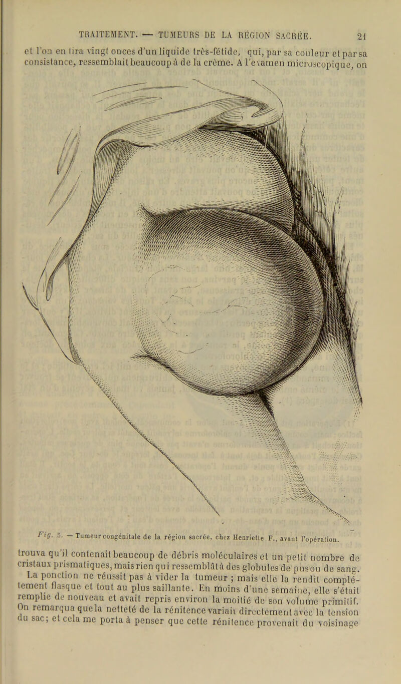 et l’on en lira vingt onces d’un liquide très-fétide, qui, par sa couleur et parsa consistance, ressemblait beaucoup à de la crème. A l'examen microscopique, on Fig. 5. — Tumeur congénitale de la région sacrée, chez Henriette F., avant l’opération. trouva qu’il contenait beaucoup de débris moléculaires et un petit nombre de cristaux prismatiques, mais rien qui ressemblai des globules de pus ou de sans. La ponction ne réussit pas à vider la tumeur ; mais elle la rendit complè- tement flasque et tout au plus saillante. En moins d’une semaine, elle s’était remplie de nouveau et avait repris environ la moitié de son volume primitif. On remarqua quela netteté de la rénitence variait directement avec la tension f u sac, e ce a me porta ù penser que cette rénitence provenait du voisinage