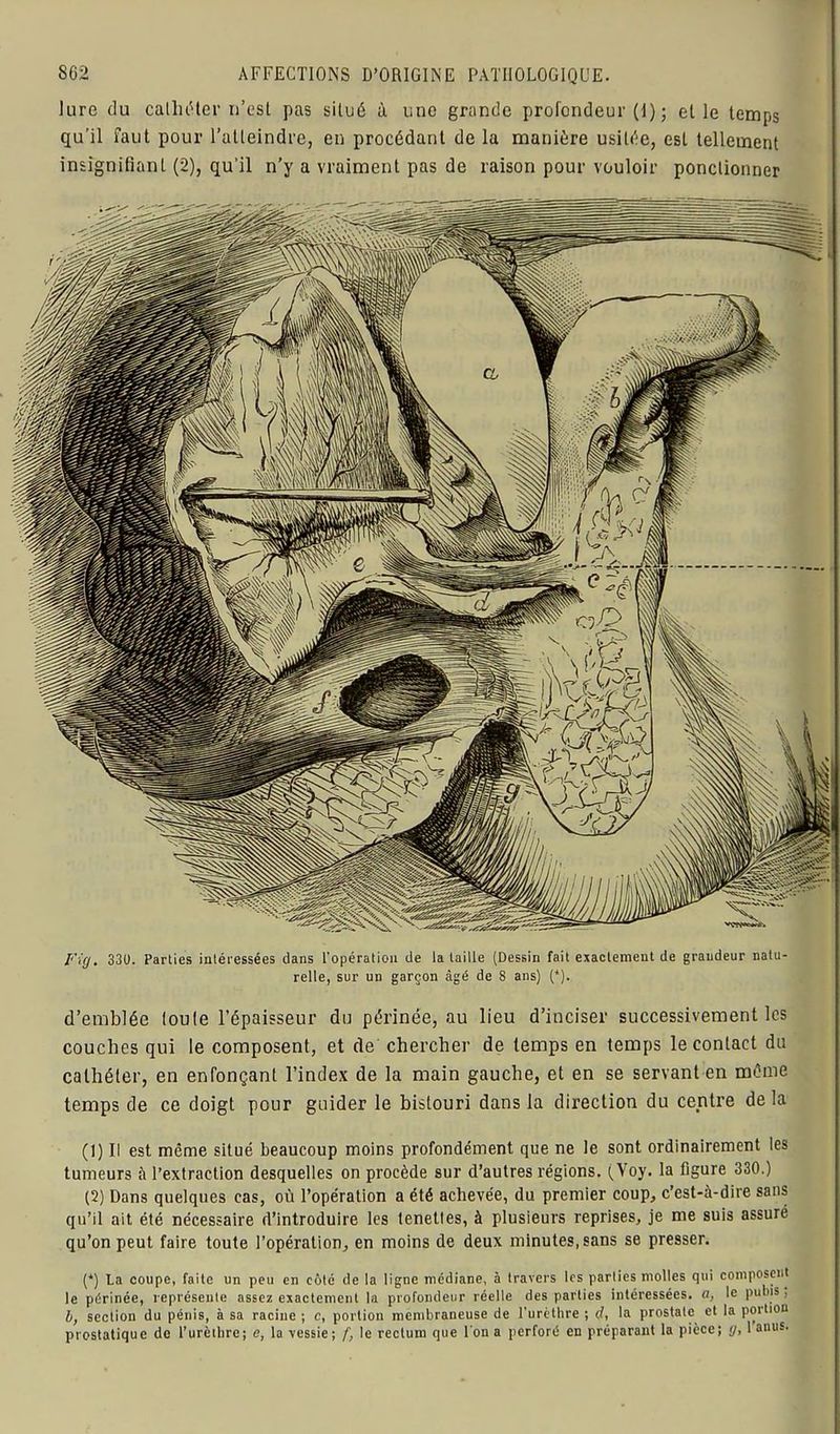 lure du cathéter n’est pas situé à une grande profondeur (I) ; elle temps qu’il faut pour l’atteindre, en procédant de la manière usitée, est tellement insignifiant (2), qu’il n’y a vraiment pas de raison pour vouloir ponctionner l'ùj. 33U. Parties intéressées dans l’opération de la taille (Dessin fait exactement de grandeur natu- relle, sur un garçon âgé de 8 ans) (*). d’emblée toute l’épaisseur du périnée, au lieu d’inciser successivement les couches qui le composent, et de chercher de temps en temps le contact du cathéter, en enfonçant l’index de la main gauche, et en se servant en même temps de ce doigt pour guider le bistouri dans la direction du centre delà (1) Il est même situé beaucoup moins profondément que ne le sont ordinairement les tumeurs à l’extraction desquelles on procède sur d’autres régions. (Voy. la figure 330.) (2) Dans quelques cas, où l’opération a été achevée, du premier coup, c’est-à-dire sans qu’il ait été nécessaire d’introduire les tenetles, à plusieurs reprises, je me suis assuré qu’on peut faire toute l’opération, en moins de deux minutes, sans se presser. (*) La coupe, faite un peu en côté de la ligne médiane, à travers les parties molles qui composent le périnée, représente assez exactement la profondeur réelle des parties intéressées, a, le pubis, h, section du pénis, à sa racine ; c, portion membraneuse de l'urèthre ; d, la prostate et la portion prostatique de l’urèthre; e, la vessie; f, le rectum que l'on a perforé en préparant la pièce; g, 1 auus.