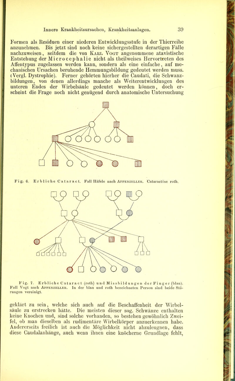 Formen als Residuen einer niederen Entwicklungsstufe in der Tkierreihe anzunehmen. Bis jetzt sind noch keine sichergestellten derartigen Fälle nachzuweisen, seitdem die von Karl Vogt angenommene atavistische Entstehung der Microcephalie nicht als theilweises Hervortreten des Affentypus zugelassen werden kann, sondern als eine einfache, auf me- chanischen Ursachen beruhende Hemmungsbildung gedeutet werden muss. (Vergl. Dystrophie). Ferner gehörten hierher die Caudati, die Schwanz- bildungen, von denen allerdings manche als Weiterentwicklungen des unteren Endes der Wirbelsäule gedeutet werden können, doch er- scheint die Frage noch nicht genügend durch anatomische Untersuchung Pig. G. Erbliche Cataract. Pall Häfele nach Appenzeller. Cataractöse roth. Fig. 7. Erbliche Cataract (roth) und Missbildungen der Finger (blau). Pall Vogt nach Appenzeller. In der blau und roth bezeichueten Person sind beide Stö- rungen vereinigt. geklärt zu sein, welche sich auch auf die Beschaffenheit der 'Wirbel- säule zu erstrecken hätte. Die meisten dieser sog. Schwänze enthalten keine Knochen und, sind solche vorhanden, so bestehen gewöhnlich Zwei- fel, ob man dieselben als rudimentäre Wirbelkörper anzuerkennen habe. Andererseits freilich ist auch die Möglichkeit nicht abzuleugnen, dass diese Caudalanhänge, auch wenn ihnen eine knöcherne Grundlage fehlt,